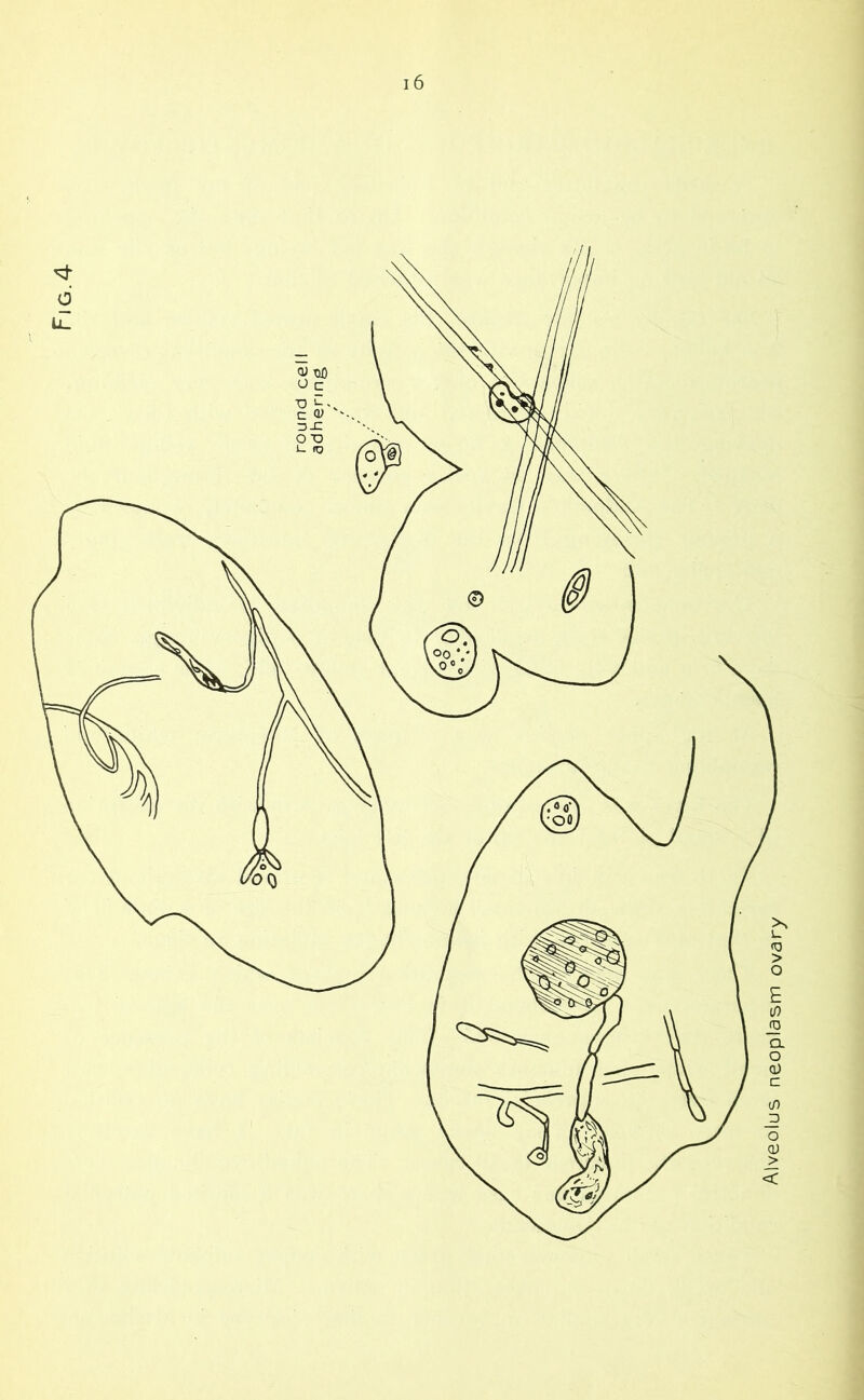 Alveolus neoplasm ovary