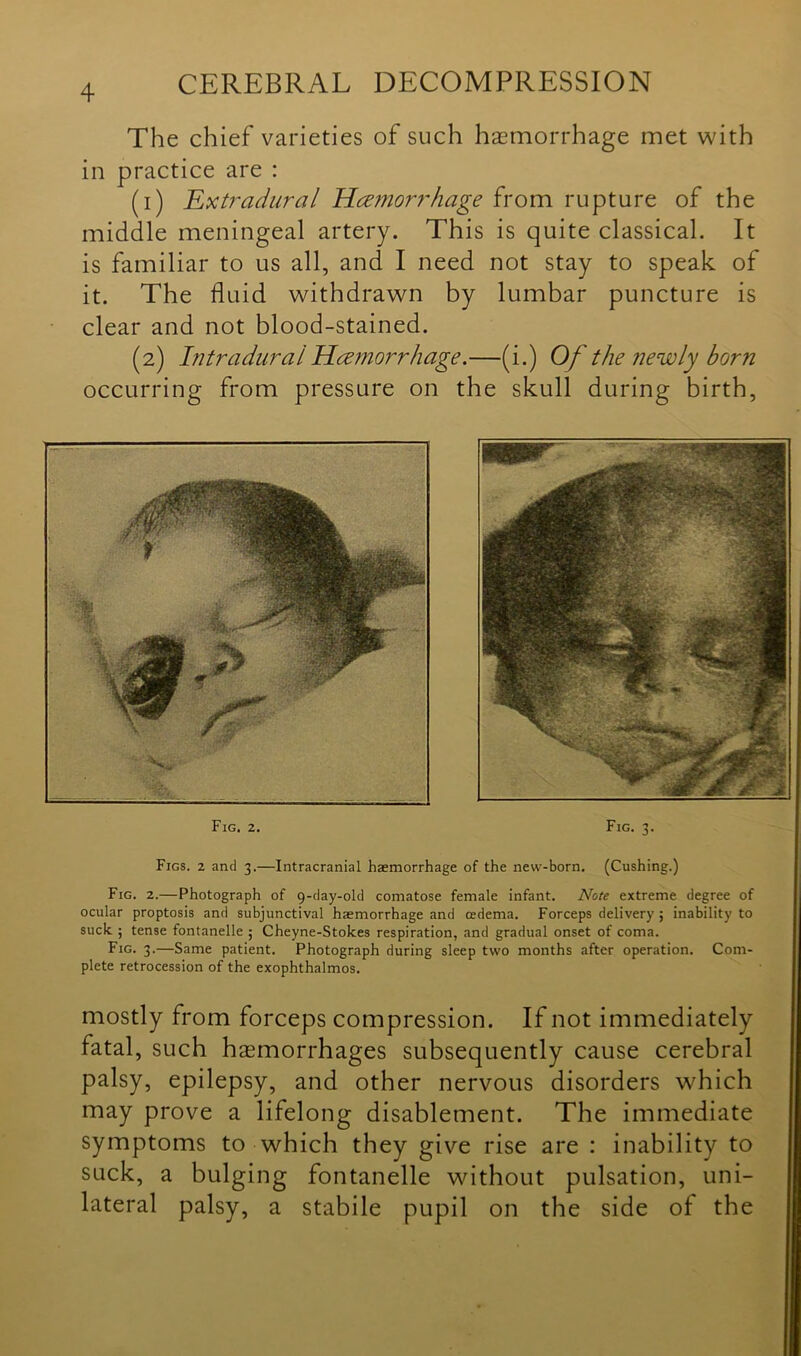 The chief varieties of such hemorrhage met with in practice are : (1) Extradural Haemorrhage from rupture of the middle meningeal artery. This is quite classical. It is familiar to us all, and I need not stay to speak of it. The fluid withdrawn by lumbar puncture is clear and not blood-stained. (2) Intradural Haemorrhage.—(i.) Of the newly born occurring from pressure on the skull during birth, Fig. 2. Fig. 3. Figs. 2 and 3.—Intracranial haemorrhage of the new-born. (Cushing.) Fig. 2.—Photograph of 9-day-old comatose female infant. Note extreme degree of ocular proptosis and subjunctival haemorrhage and oedema. Forceps delivery ; inability to suck.; tense fontanelle ; Cheyne-Stokes respiration, and gradual onset of coma. Fig. 3.—Same patient. Photograph during sleep two months after operation. Com- plete retrocession of the exophthalmos. mostly from forceps compression. If not immediately fatal, such haemorrhages subsequently cause cerebral palsy, epilepsy, and other nervous disorders which may prove a lifelong disablement. The immediate symptoms to which they give rise are : inability to suck, a bulging fontanelle without pulsation, uni- lateral palsy, a stabile pupil on the side of the