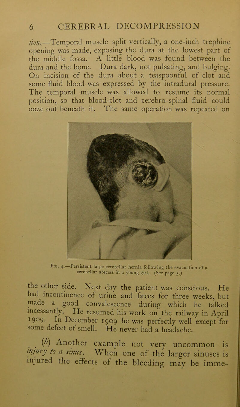 tion.—Temporal muscle split vertically, a one-inch trephine opening was made, exposing the dura at the lowest part of the middle fossa. A little blood was found between the dura and the bone. Dura dark, not pulsating, and bulging. On incision of the dura about a teaspoonful of clot and some fluid blood was expressed by the intradural pressure. The temporal muscle was allowed to resume its normal position, so that blood-clot and cerebro-spinal fluid could ooze out beneath it. The same operation was repeated on Fig. 4. Persistent large cerebellar hernia following the evacuation of a cerebellar abscess in a young girl. (See page 5.) the other side. Next day the patient was conscious. He had incontinence of urine and fasces for three weeks, but made a good convalescence during which he talked incessantly. He resumed his work on the railway in April 19°9- In December 1909 he was perfectly well except for some defect of smell. He never had a headache. . . (^) Another example not very uncommon is injury to a sinus. When one of the larger sinuses is injuied the effects of the bleeding may be imme-