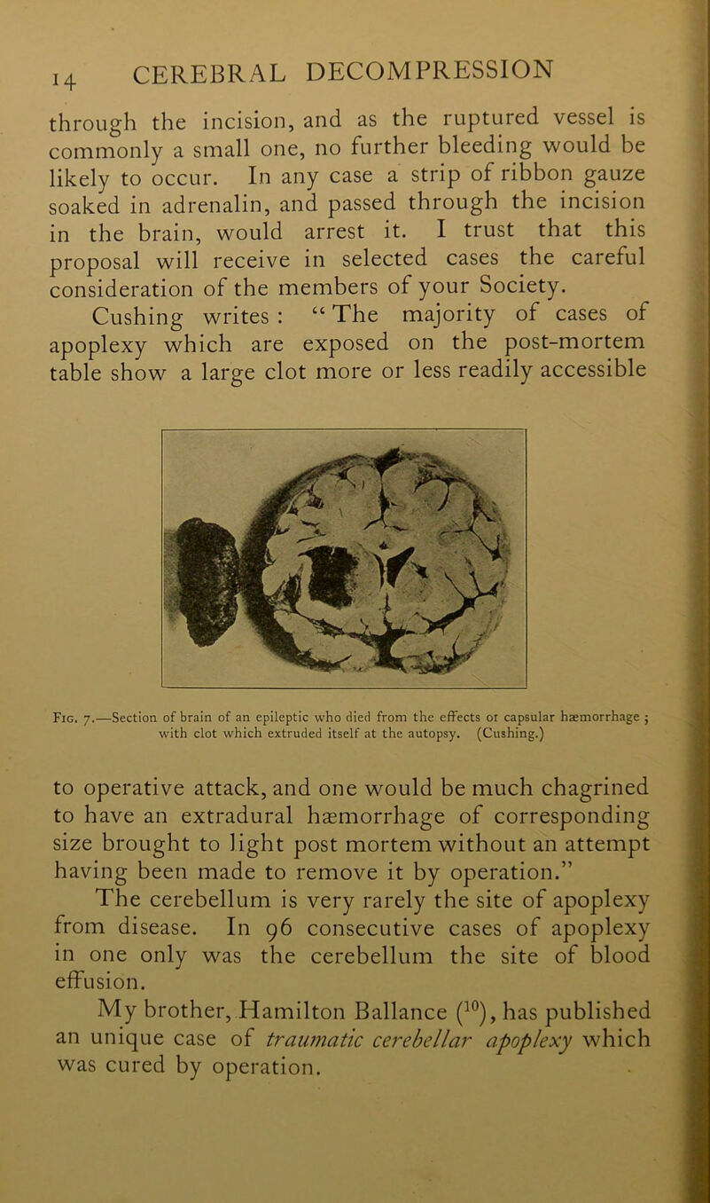through the incision, and as the ruptured vessel is commonly a small one, no further bleeding would be likely to occur. In any case a strip of ribbon gauze soaked in adrenalin, and passed through the incision in the brain, would arrest it. I trust that this proposal will receive in selected cases the careful consideration of the members of your Society. Cushing writes : “ The majority of cases of apoplexy which are exposed on the post-mortem table show a large clot more or less readily accessible Fig. 7.—Section of brain of an epileptic who died from the effects or capsular haemorrhage ; with clot which extruded itself at the autopsy. (Cushing.) to operative attack, and one would be much chagrined to have an extradural haemorrhage of corresponding size brought to light post mortem without an attempt having been made to remove it by operation.” The cerebellum is very rarely the site of apoplexy from disease. In 96 consecutive cases of apoplexy in one only was the cerebellum the site of blood effusion. My brother, Hamilton Ballance (10), has published an unique case of traumatic cerebellar apoplexy which was cured by operation.