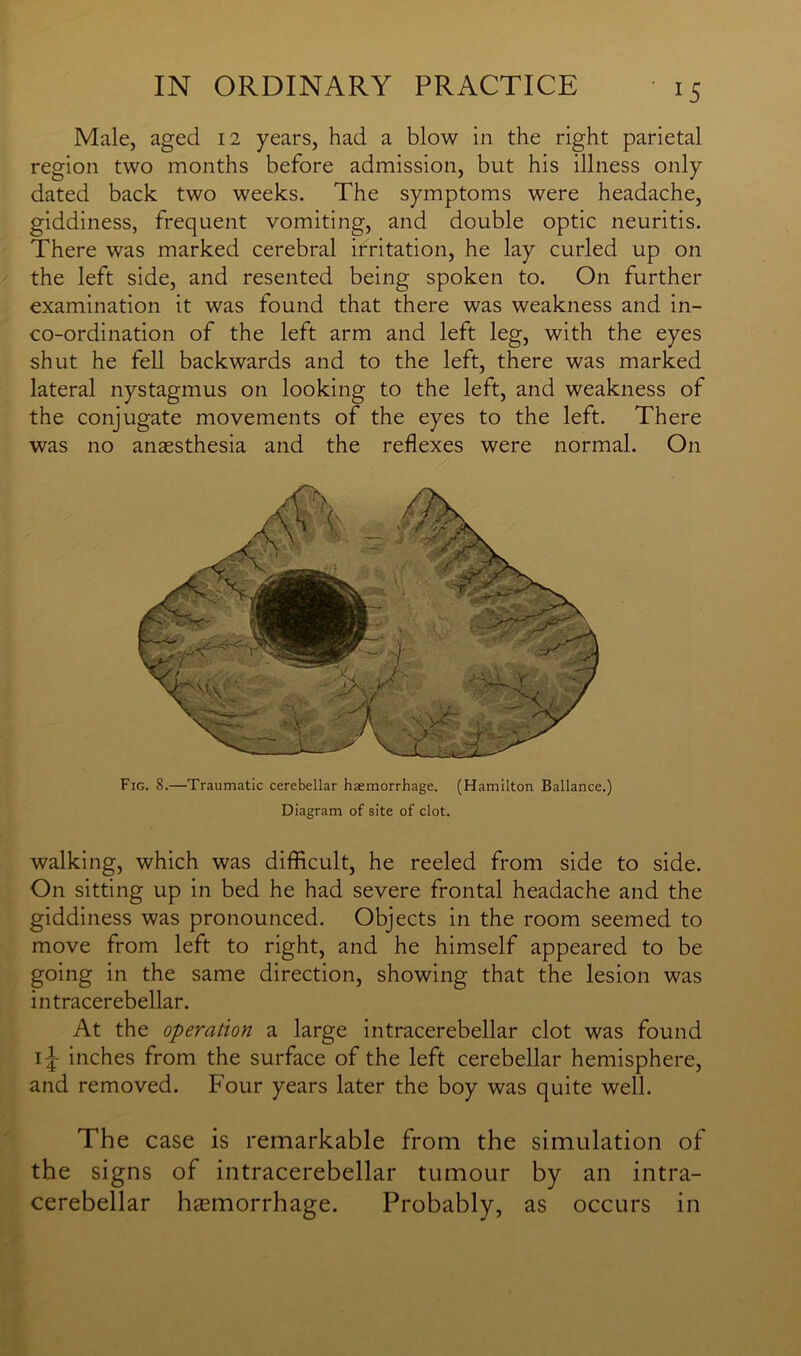 J5 Male, aged 12 years, had a blow in the right parietal region two months before admission, but his illness only dated back two weeks. The symptoms were headache, giddiness, frequent vomiting, and double optic neuritis. There was marked cerebral irritation, he lay curled up on the left side, and resented being spoken to. On further examination it was found that there was weakness and in- co-ordination of the left arm and left leg, with the eyes shut he fell backwards and to the left, there was marked lateral nystagmus on looking to the left, and weakness of the conjugate movements of the eyes to the left. There was no anaesthesia and the reflexes were normal. On Fig. 8.—Traumatic cerebellar haemorrhage. (Hamilton Ballance.) Diagram of site of clot. walking, which was difficult, he reeled from side to side. On sitting up in bed he had severe frontal headache and the giddiness was pronounced. Objects in the room seemed to move from left to right, and he himself appeared to be going in the same direction, showing that the lesion was intracerebellar. At the operation a large intracerebellar clot was found 1J inches from the surface of the left cerebellar hemisphere, and removed. Four years later the boy was quite well. The case is remarkable from the simulation of the signs of intracerebellar tumour by an intra- cerebellar haemorrhage. Probably, as occurs in