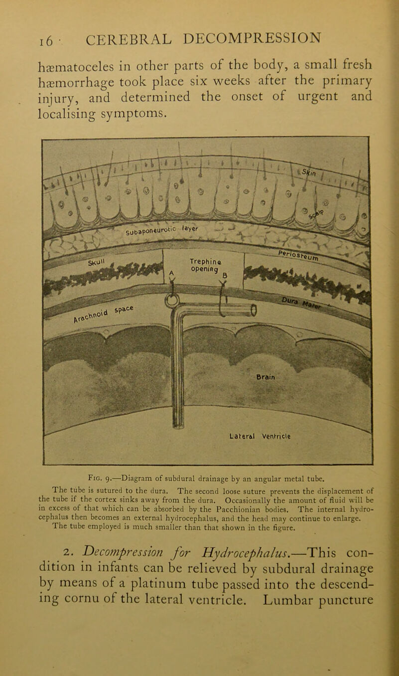 hematoceles in other parts of the body, a small fresh hemorrhage took place six weeks after the primary injury, and determined the onset of urgent and localising symptoms. Fig. 9.—Diagram of subdural drainage by an angular metal tube. The tube is sutured to the dura. The second loose suture prevents the displacement of the tube if the cortex sinks away from the dura. Occasionally the amount of fluid will be in excess of that which can be absorbed by the Pacchionian bodies. The internal hydro- cephalus then becomes an external hydrocephalus, and the head may continue to enlarge. The tube employed is much smaller than that shown in the figure. 2. Decompression for Hydrocephalus.—This con- dition in infants can be relieved by subdural drainage by means of a platinum tube passed into the descend- ing cornu of the lateral ventricle. Lumbar puncture