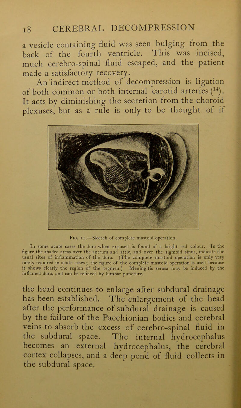 a vesicle containing fluid was seen bulging from the back of the fourth ventricle. This was incised, much cerebro-spinal fluid escaped, and the patient made a satisfactory recovery. An indirect method of decompression is ligation of both common or both internal carotid arteries (u). It acts by diminishing the secretion from the choroid plexuses, but as a rule is only to be thought of if Fig. ii.—Sketch of complete mastoid operation. In some acute cases the dura when exposed is found of a bright red colour. In the figure the shaded areas over the antrum and attic, and over the sigmoid sinus, indicate the usual sites of inflammation of the dura. (The complete mastoid operation is only very rarely required in acute cases ; the figure of the complete mastoid operation is used because it shows clearly the region of the tegmen.) Meningitis serosa may be induced by the inflamed dura, and can be relieved by lumbar puncture. the head continues to enlarge after subdural drainage has been established. The enlargement of the head after the performance of subdural drainage is caused by the failure of the Pacchionian bodies and cerebral veins to absorb the excess of cerebro-spinal fluid in the subdural space. The internal hydrocephalus becomes an external hydrocephalus, the cerebral cortex collapses, and a deep pond of fluid collects in the subdural space.