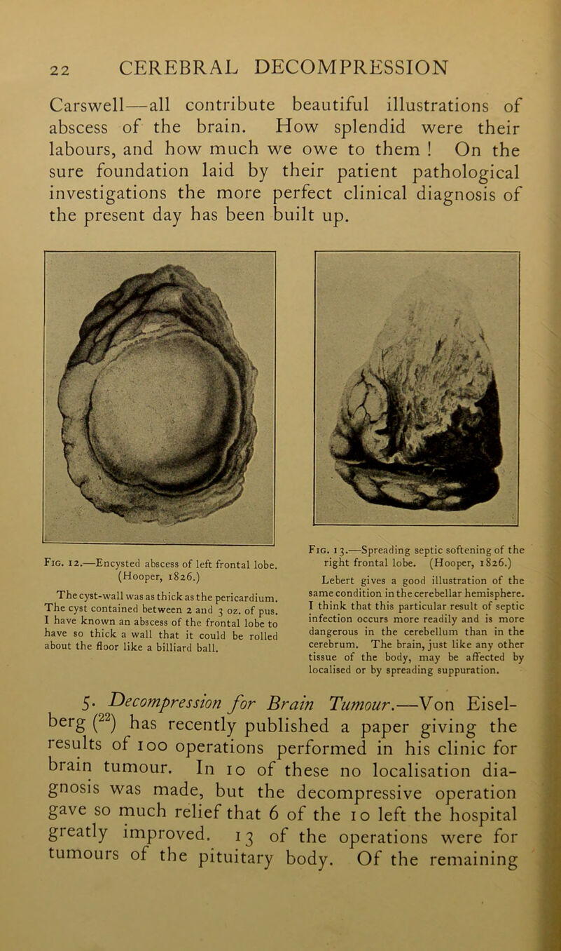 Carswell—all contribute beautiful illustrations of abscess of the brain. How splendid were their labours, and how much we owe to them ! On the sure foundation laid by their patient pathological investigations the more perfect clinical diagnosis of the present day has been built up. Fig. 12.—Encysted abscess of left frontal lobe. (Hooper, 1826.) The cyst-wall was as thick as the pericardium. The cyst contained between 2 and 3 oz. of pus. I have known an abscess of the frontal lobe to have so thick a wall that it could be rolled about the floor like a billiard ball. Fig. 13.—Spreading septic softening of the right frontal lobe. (Hooper, 1826.) Lebert gives a good illustration of the same condition in the cerebellar hemisphere. I think that this particular result of septic infection occurs more readily and is more dangerous in the cerebellum than in the cerebrum. The brain, just like any other tissue of the body, may be affected by localised or by spreading suppuration. 5- Decompression for Brain Tumour.—Von Eisel- berg (2“) has recently published a paper giving the results of ioo operations performed in his clinic for brain tumour. In io of these no localisation dia- gnosis was made, but the decompressive operation gave so much relief that 6 of the io left the hospital gieatly improved. 13 of the operations were for tumours of the pituitary body. Of the remaining
