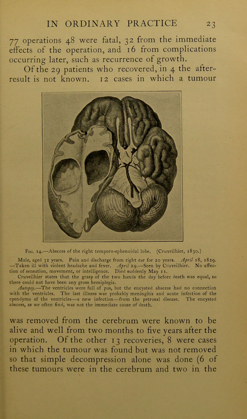 77 operations 48 were fatal, 32 from the immediate effects of the operation, and 16 from complications occurring later, such as recurrence of growth. Of the 29 patients who recovered, in 4 the after- result is not known. 12 cases in which a tumour Fig. 14.—Abscess of the right temporo-sphenoidal lobe. (Cruveilhier, 1830.) Male, aged 32 years. Pain and discharge from right ear for 20 years. April 18, 1829. —Taken ill with violent headache and fever. April 29.—Seen by Cruveilhier. No affec- tion of sensation, movement, or intelligence. Died suddenly May r 1. Cruveilhier states that the grasp of the two hands the day before death was equal, so there could not have been any gross hemiplegia. Autopsy.—The ventricles were full of pus, but the encysted abscess had no connection with the ventricles. The last illness was probably meningitis and acute infection of the ependyma of the ventricles—a new infection—from the petrosal disease. The encysted abscess, as we often find, was not the immediate cause of death. was removed from the cerebrum were known to be alive and well from two months to five years after the operation. Of the other 13 recoveries, 8 were cases in which the tumour was found but was not removed so that simple decompression alone was done (6 of these tumours were in the cerebrum and two in the