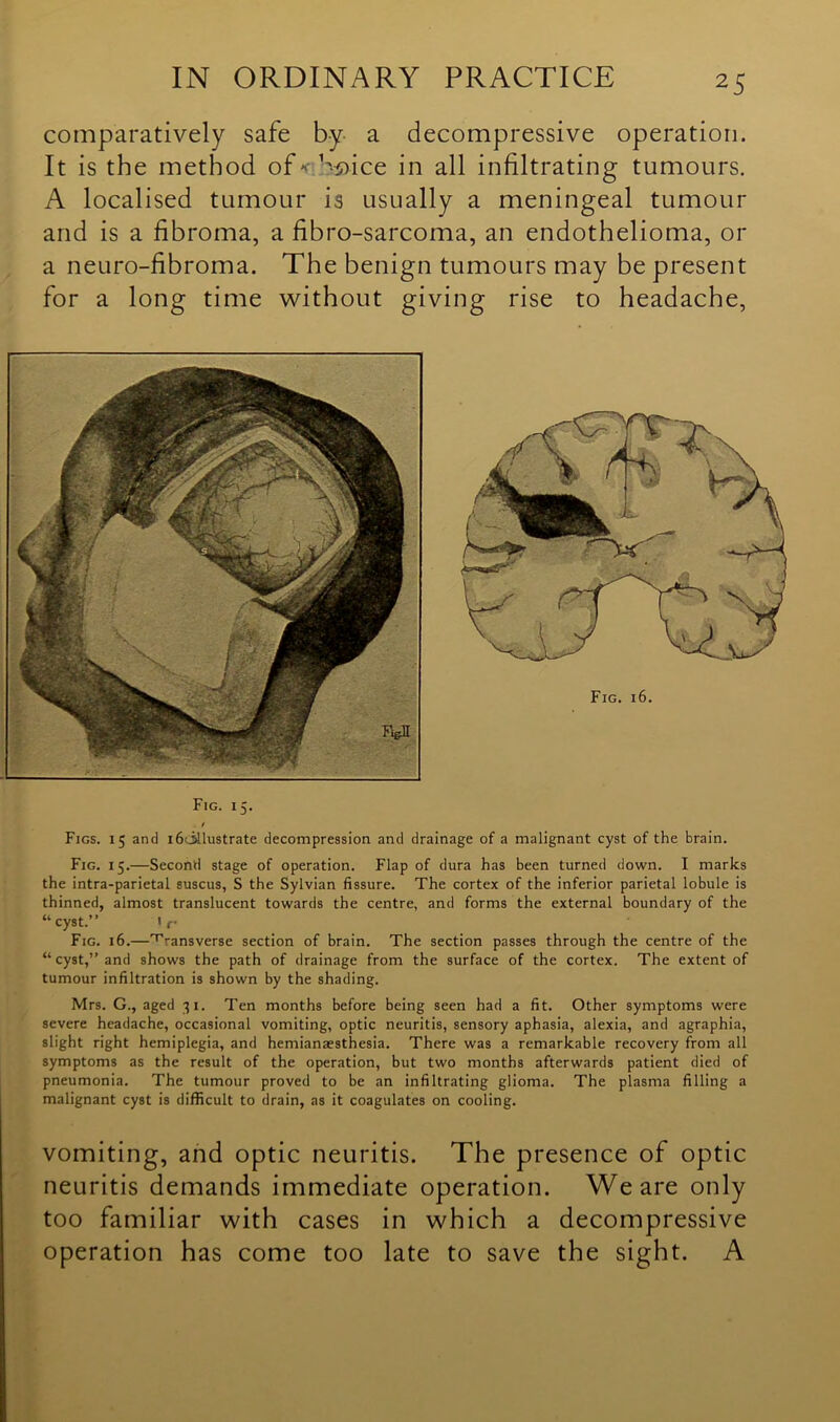 comparatively safe by a decompressive operation. It is the method of* bsdce in all infiltrating tumours. A localised tumour is usually a meningeal tumour and is a fibroma, a fibro-sarcoma, an endothelioma, or a neuro-fibroma. The benign tumours may be present for a long time without giving rise to headache, Fig. 16. Fig. 15. Figs. 15 and i6cMlustrate decompression and drainage of a malignant cyst of the brain. Fig. 15.—Second stage of operation. Flap of dura has been turned down. I marks the intra-parietal suscus, S the Sylvian fissure. The cortex of the inferior parietal lobule is thinned, almost translucent towards the centre, and forms the external boundary of the “cyst.” Fig. 16.—transverse section of brain. The section passes through the centre of the “ cyst,” and shows the path of drainage from the surface of the cortex. The extent of tumour infiltration is shown by the shading. Mrs. G., aged 31. Ten months before being seen had a fit. Other symptoms were severe headache, occasional vomiting, optic neuritis, sensory aphasia, alexia, and agraphia, slight right hemiplegia, and hemianaesthesia. There was a remarkable recovery from all symptoms as the result of the operation, but two months afterwards patient died of pneumonia. The tumour proved to be an infiltrating glioma. The plasma filling a malignant cyst is difficult to drain, as it coagulates on cooling. vomiting, and optic neuritis. The presence of optic neuritis demands immediate operation. We are only too familiar with cases in which a decompressive operation has come too late to save the sight. A