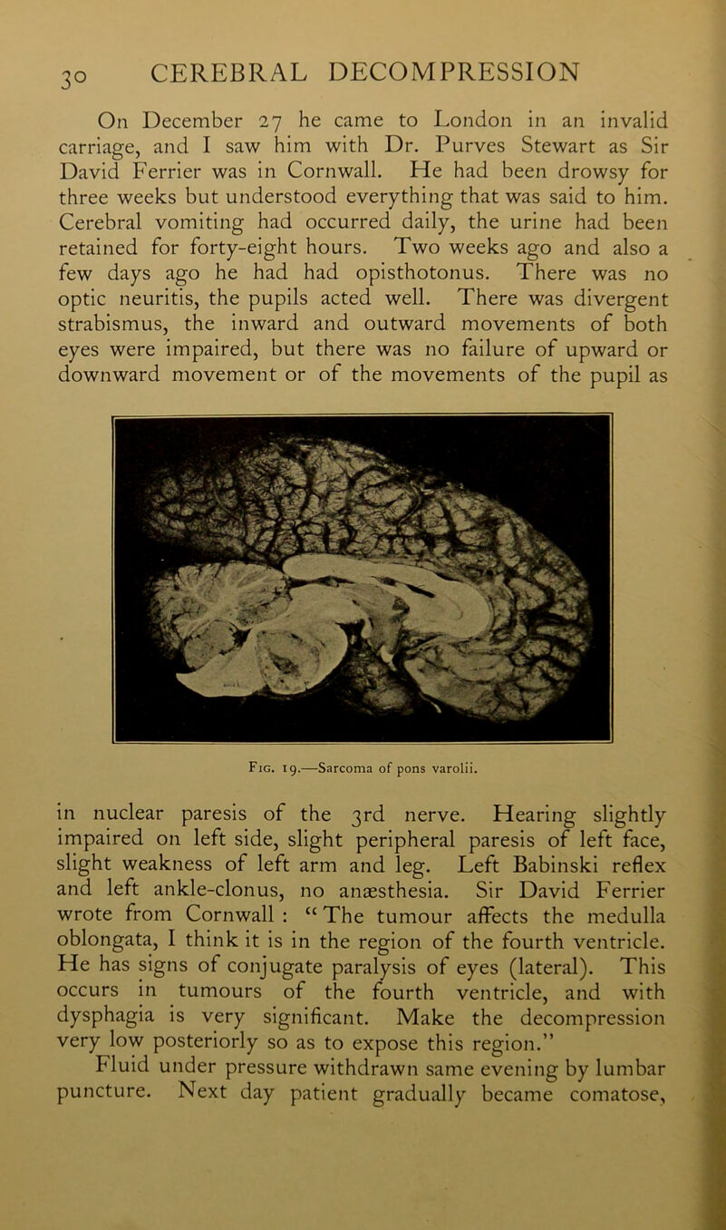 3° On December 27 he came to London in an invalid carriage, and I saw him with Dr. Purves Stewart as Sir David Ferrier was in Cornwall. He had been drowsy for three weeks but understood everything that was said to him. Cerebral vomiting had occurred daily, the urine had been retained for forty-eight hours. Two weeks ago and also a few days ago he had had opisthotonus. There was no optic neuritis, the pupils acted well. There was divergent strabismus, the inward and outward movements of both eyes were impaired, but there was no failure of upward or downward movement or of the movements of the pupil as Fig. 19.—Sarcoma of pons varolii. in nuclear paresis of the 3rd nerve. Hearing slightly impaired on left side, slight peripheral paresis of left face, slight weakness of left arm and leg. Left Babinski reflex and left ankle-clonus, no anaesthesia. Sir David Ferrier wrote from Cornwall : u The tumour affects the medulla oblongata, I think it is in the region of the fourth ventricle. He has signs of conjugate paralysis of eyes (lateral). This occurs in tumours of the fourth ventricle, and with dysphagia is very significant. Make the decompression very low posteriorly so as to expose this region.” Fluid under pressure withdrawn same evening by lumbar puncture. Next day patient gradually became comatose,