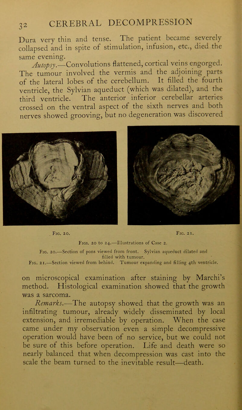 Dura very thin and tense. The patient became severely collapsed and in spite of stimulation, infusion, etc., died the same evening. Autopsy.—Convolutions flattened, cortical veins engorged. The tumour involved the vermis and the adjoining parts of the lateral lobes of the cerebellum. It filled the fourth ventricle, the Sylvian aqueduct (which was dilated), and the third ventricle. The anterior inferior cerebellar arteries crossed on the ventral aspect of the sixth nerves and both nerves showed grooving, but no degeneration was discovered Fig. 20. Fig. 2i. Figs. 20 to 24.—Illustrations of Case 2. Fig. 20.—Section of pons viewed from front. Sylvian aqueduct dilated and filled with tumour. Fig. 21.—Section viewed from behind. Tumour expanding and filling 4th ventricle. on microscopical examination after staining by Marchi’s method. Histological examination showed that the growth was a sarcoma. Remarks.—The autopsy showed that the growth was an infiltrating tumour, already widely disseminated by local extension, and irremediable by operation. When the case came under my observation even a simple decompressive operation would have been of no service, but we could not be sure of this before operation. Life and death were so nearly balanced that when decompression was cast into the scale the beam turned to the inevitable result—death.