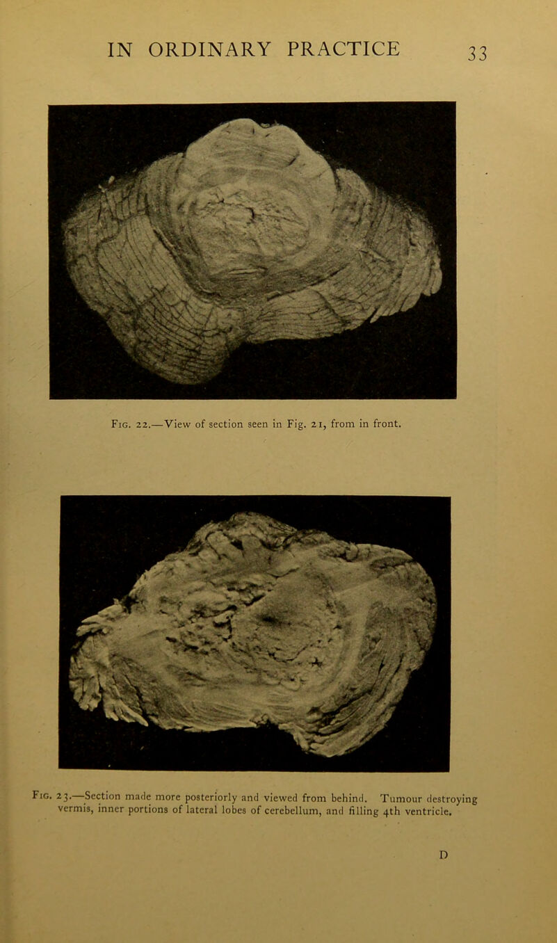 Fig. 22.—View of section seen in Fig. 21, from in front. Fig. 23.—Section made more posteriorly and viewed from behind. Tumour destroying vermis, inner portions of lateral lobes of cerebellum, and filling 4th ventricle. D