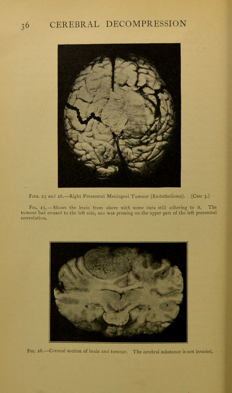 Figs. 25 and 26.—Right Precentral Meningeal Tumour (Endothelioma). (Case 3.) Fig. 25. — Shows the brain from above with some dura still adhering to it. The tumour had crossed to the left side, ana was pressing on the upper part of the left precentral convolution. Fig. 26.—Coronal section of brain and tumour. The cerebral substance is not invaded.