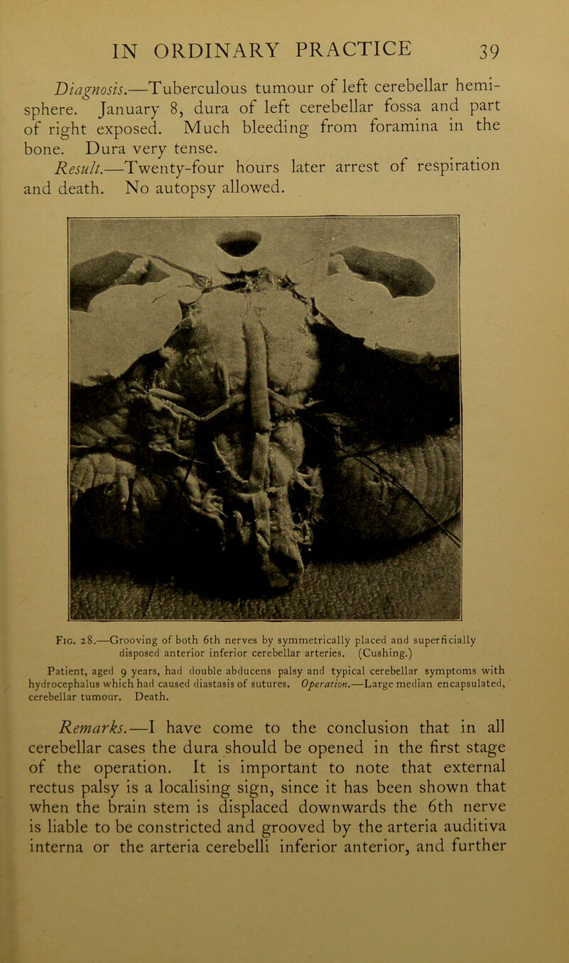 Diagnosis.—Tuberculous tumour ot left cerebellar hemi- sphere. January 8, dura of left cerebellar fossa and part of right exposed. Much bleeding from foramina in the bone. Dura very tense. Result.—Twenty-four hours later arrest of respiration and death. No autopsy allowed. Fig. 28.—Grooving of both 6th nerves by symmetrically placed and superficially disposed anterior inferior cerebellar arteries. (Cushing.) Patient, aged 9 years, had double abducens palsy and typical cerebellar symptoms with hydrocephalus which had caused diastasis of sutures. Operation.—Large median encapsulated, cerebellar tumour. Death. Remarks.—I have come to the conclusion that in all cerebellar cases the dura should be opened in the first stage of the operation. It is important to note that external rectus palsy is a localising sign, since it has been shown that when the brain stem is displaced downwards the 6th nerve is liable to be constricted and grooved by the arteria auditiva interna or the arteria cerebelli inferior anterior, and further