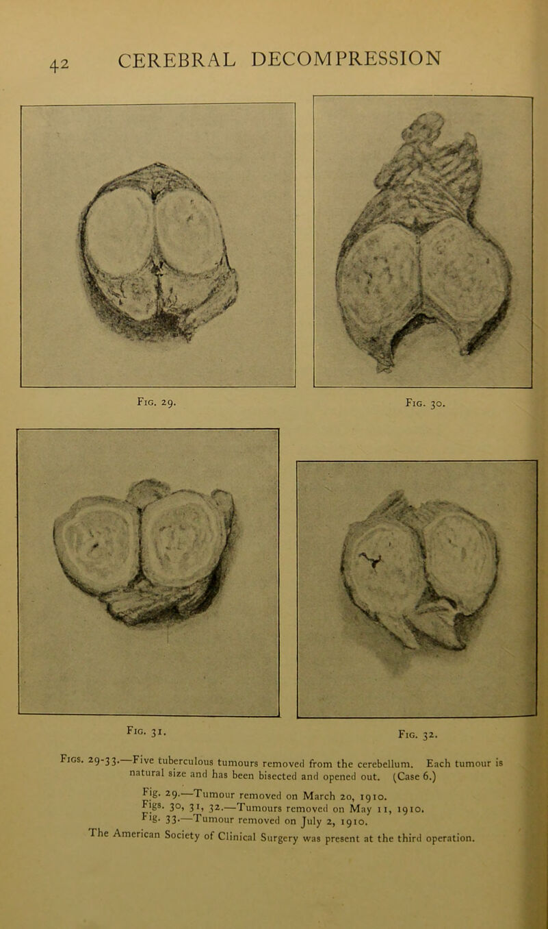 Fig. 31. Fig. 32. Figs. 29-33. Five tuberculous tumours removed from the cerebellum. Each tumour is natural size and has been bisected and opened out. (Case 6.) Fig. 29, Tumour removed on March 20, 1910. Figs. 30, 31, 32.—Tumours removed on May 11, 1910. ***§• 33* Tumour removed on July 2, 1910. The American Society of Clinical Surgery was present at the third operation.