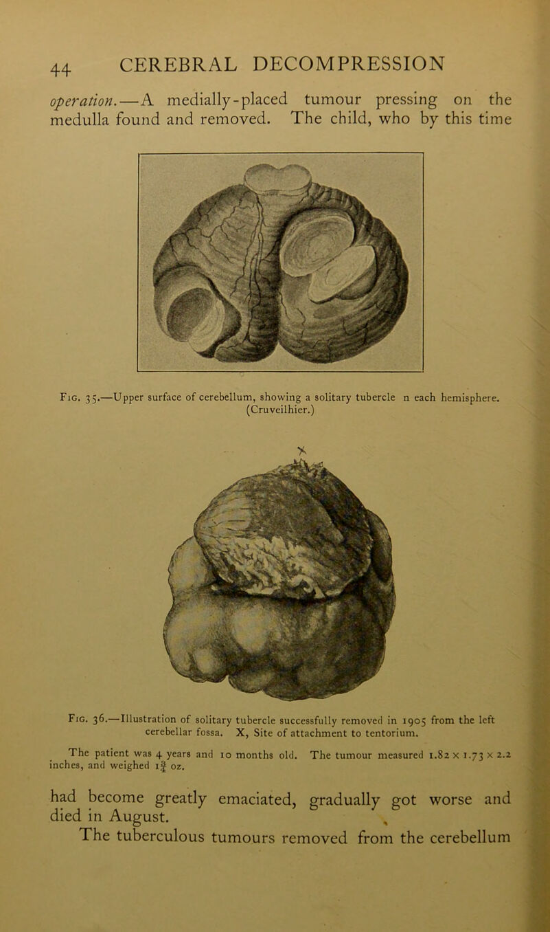 operation.—A medially-placed tumour pressing on the medulla found and removed. The child, who by this time Fig. 35.—Upper surface of cerebellum, showing a solitary tubercle n each hemisphere. (Cruveilhier.) Fig. 36.—Illustration of solitary tubercle successfully removed in 1905 from the left cerebellar fossa. X, Site of attachment to tentorium. The patient was 4 years and 10 months old. The tumour measured 1.82 x 1.73 x 2.2 inches, and weighed ij oz. had become greatly emaciated, gradually got worse and died in August. The tuberculous tumours removed from the cerebellum