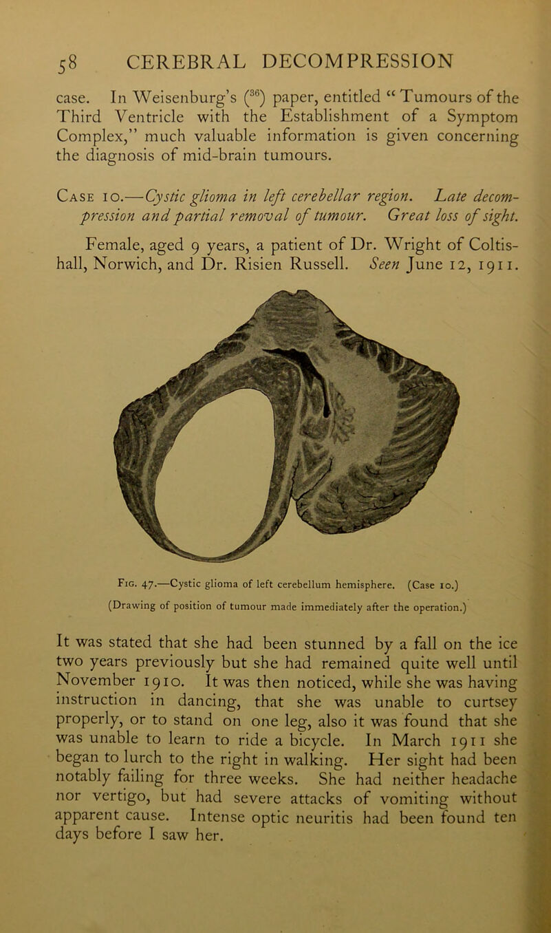 case. In Weisenburg’s (36) paper, entitled “Tumours of the Third Ventricle with the Establishment of a Symptom Complex,” much valuable information is given concerning the diagnosis of mid-brain tumours. Case io.—Cystic glioma in left cerebellar region, hate decom- pression and partial removal of tumour. Great loss of sight. Female, aged 9 years, a patient of Dr. Wright of Coltis- hall, Norwich, and Dr. Risien Russell. Seen June 12, 1911. Fig. 47.—Cystic glioma of left cerebellum hemisphere. (Case io.) (Drawing of position of tumour made immediately after the operation.) It was stated that she had been stunned by a fall on the ice two years previously but she had remained quite well until November 1910. It was then noticed, while she was having instruction in dancing, that she was unable to curtsey properly, or to stand on one leg, also it was found that she was unable to learn to ride a bicycle. In March 1911 she began to lurch to the right in walking. Her sight had been notably failing for three weeks. She had neither headache nor vertigo, but had severe attacks of vomiting without apparent cause. Intense optic neuritis had been found ten days before I saw her.