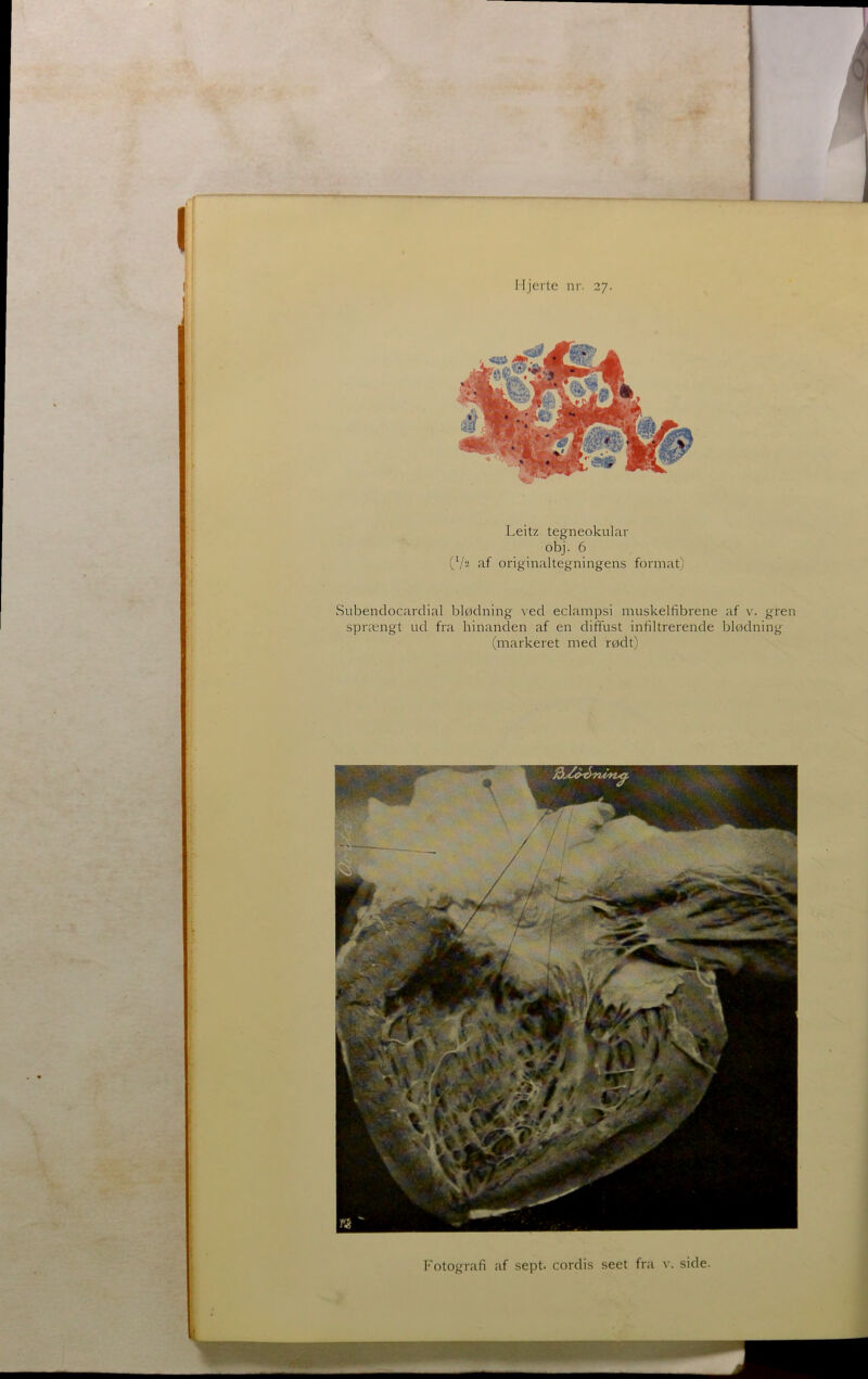 Leitz tegneokulav obj. 6 (V2 af originaltegningens format) Subendocarclial blødning ved eclampsi muskelfibrene af v. gren sprængt ud fra hinanden af en diffust infiltrerende blødning (markeret med rødt)