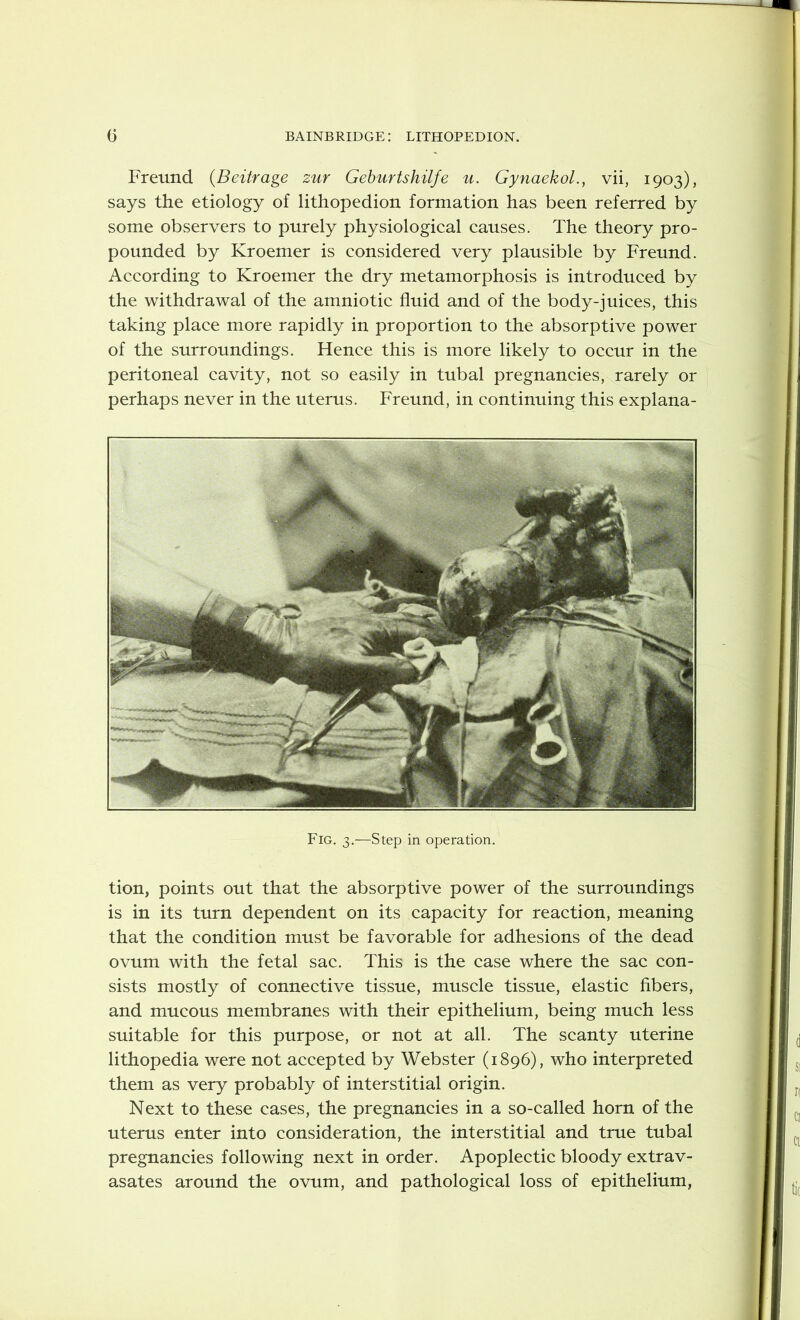 Freund (Beitrage zur Geburtshilfe u. Gynaekol., vii, 1903), says the etiology of lithopedion formation has been referred by some observers to purely physiological causes. The theory pro- pounded by Kroemer is considered very plausible by Freund. According to Kroemer the dry metamorphosis is introduced by the withdrawal of the amniotic fluid and of the body-juices, this taking place more rapidly in proportion to the absorptive power of the surroundings. Hence this is more likely to occur in the peritoneal cavity, not so easily in tubal pregnancies, rarely or perhaps never in the uterus. Freund, in continuing this explana- Fig. 3.—Step in operation. tion, points out that the absorptive power of the surroundings is in its turn dependent on its capacity for reaction, meaning that the condition must be favorable for adhesions of the dead ovum with the fetal sac. This is the case where the sac con- sists mostly of connective tissue, muscle tissue, elastic fibers, and mucous membranes with their epithelium, being much less suitable for this purpose, or not at all. The scanty uterine lithopedia were not accepted by Webster (1896), who interpreted them as very probably of interstitial origin. Next to these cases, the pregnancies in a so-called horn of the uterus enter into consideration, the interstitial and true tubal pregnancies following next in order. Apoplectic bloody extrav- asates around the ovum, and pathological loss of epithelium,