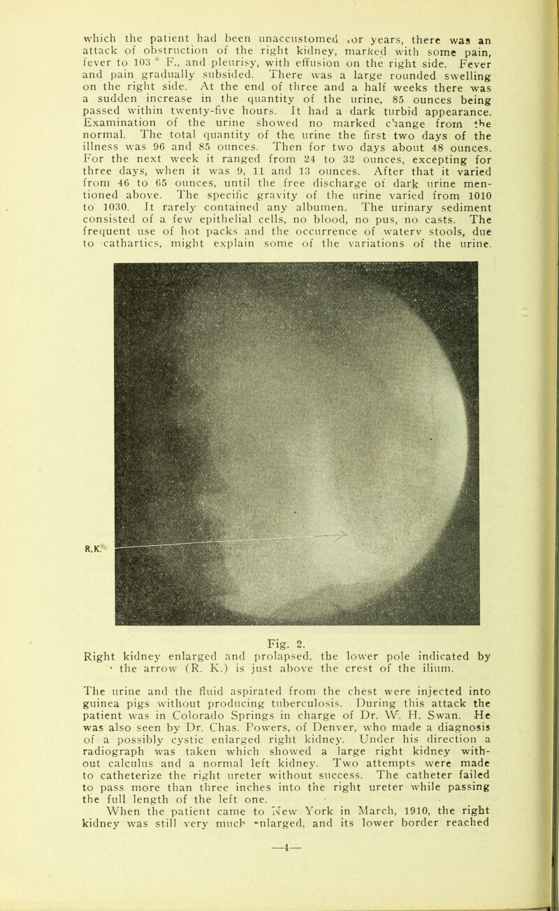 which the patient had been unaccustomed *or years, there was an attack of obstruction of the right kidney, marked with some pain, fever to 103 0 F„, and pleurisy, with effusion on the right side. Fever and pain gradually subsided. ihere was a large rounded swelling on the right side. At the end of three and a half weeks there was a sudden increase in the quantity of the urine, 85 ounces being passed within twenty-five hours. It had a dark turbid appearance. Examination of the urine showed no marked change from the normal. The total quantity of the, urine the first two days of the illness was 96 and 85 ounces. Then for two days about 48 ounces. For the next week it ranged from 24 to 32 ounces, excepting for three days, when it was 9, 11 and 13 ounces. After that it varied from 46 to 65 ounces, until the free discharge of dark urine men- tioned above. The specific gravity of the urine varied from 1010 to 1030. It rarely contained any albumen. The urinary sediment consisted of a few epithelial cells, no blood, no pus, no casts. The frequent use of hot packs and the occurrence of waterv stools, due to cathartics, might explain some of the variations of the urine. Fig. 2. Right kidney enlarged and prolapsed, the lower pole indicated by • the arrow (R. K.) is just above the crest of the ilium. The urine and the fluid aspirated from the chest were injected into guinea pigs without producing tuberculosis. During this attack the patient was in Colorado Springs in charge of Dr. W. H. Swan. He was also seen by Dr. Chas. Powers, of Denver, who made a diagnosis of a possibly cystic enlarged right kidney. Under his direction a radiograph was taken which showed a large right kidney with- out calculus and a normal left kidney. Two attempts were made to catheterize the right ureter without success. The catheter failed to pass more than three inches into the right ureter while passing the full length of the left one. When the patient came to New York in March, 1910, the right kidney was still very much enlarged, and its lower border reached —4—