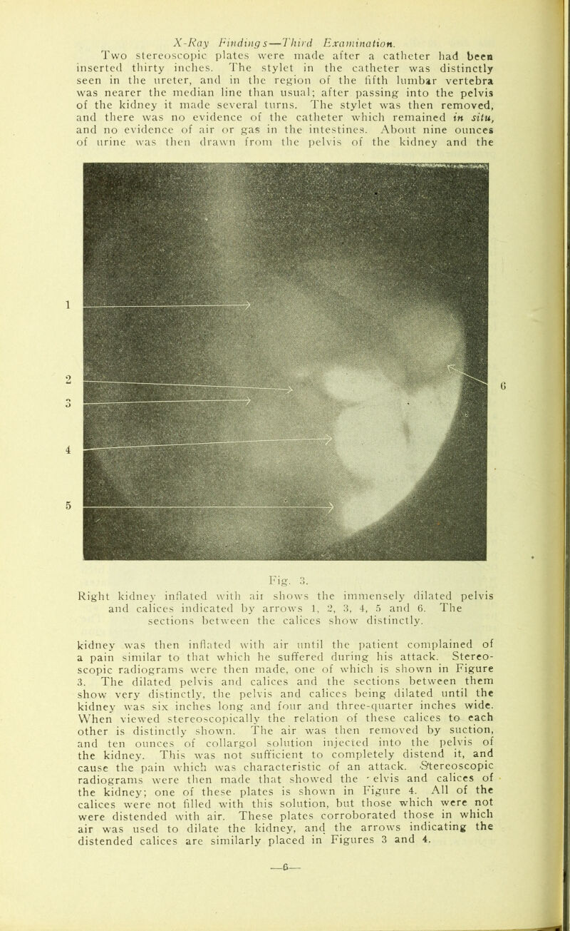 X-Ray Findings—Third Examination. Two stereoscopic plates were made after a catheter had beea inserted thirty inches. The stylet in the catheter was distinctly seen in the ureter, and in the region of the fifth lumbar vertebra was nearer the median line than usual; after passing into the pelvis of the kidney it made several turns. The stylet was then removed, and there was no evidence of the catheter which remained in situ, and no evidence of air or gas in the intestines. About nine ounces of urine was then drawn from the pelvis of the kidney and the Fig. 3. Right kidney inflated with aii shows the immensely dilated pelvis and calices indicated by arrows 1, 2, 3, 4, 5 and 6. The sections between the calices show distinctly. kidney was then inflated with air until the patient complained of a pain similar to that which he suffered during his attack. Stereo- scopic radiograms were then made, one of which is shown in Figure 3. The dilated pelvis and calices and the sections between them show very distinctly, the pelvis and calices being dilated until the kidney was six inches long and four and three-quarter inches wide. When viewed stereoscopically the relation of these calices to each other is distinctly shown. The air was then removed by suction, and ten ounces of collargol solution injected into the pelvis of the kidney. This was not sufficient to completely distend it, and cause the pain which was characteristic of an attack. -Stereoscopic radiograms were then made that showed the ' elvis and calices of the kidney; one of these plates is shown in Figure 4. All of the calices were not filled with this solution, but those which were not were distended with air. These plates corroborated those in which air was used to dilate the kidney, and the arrows indicating the distended calices are similarly placed in Figures 3 and 4. —6-