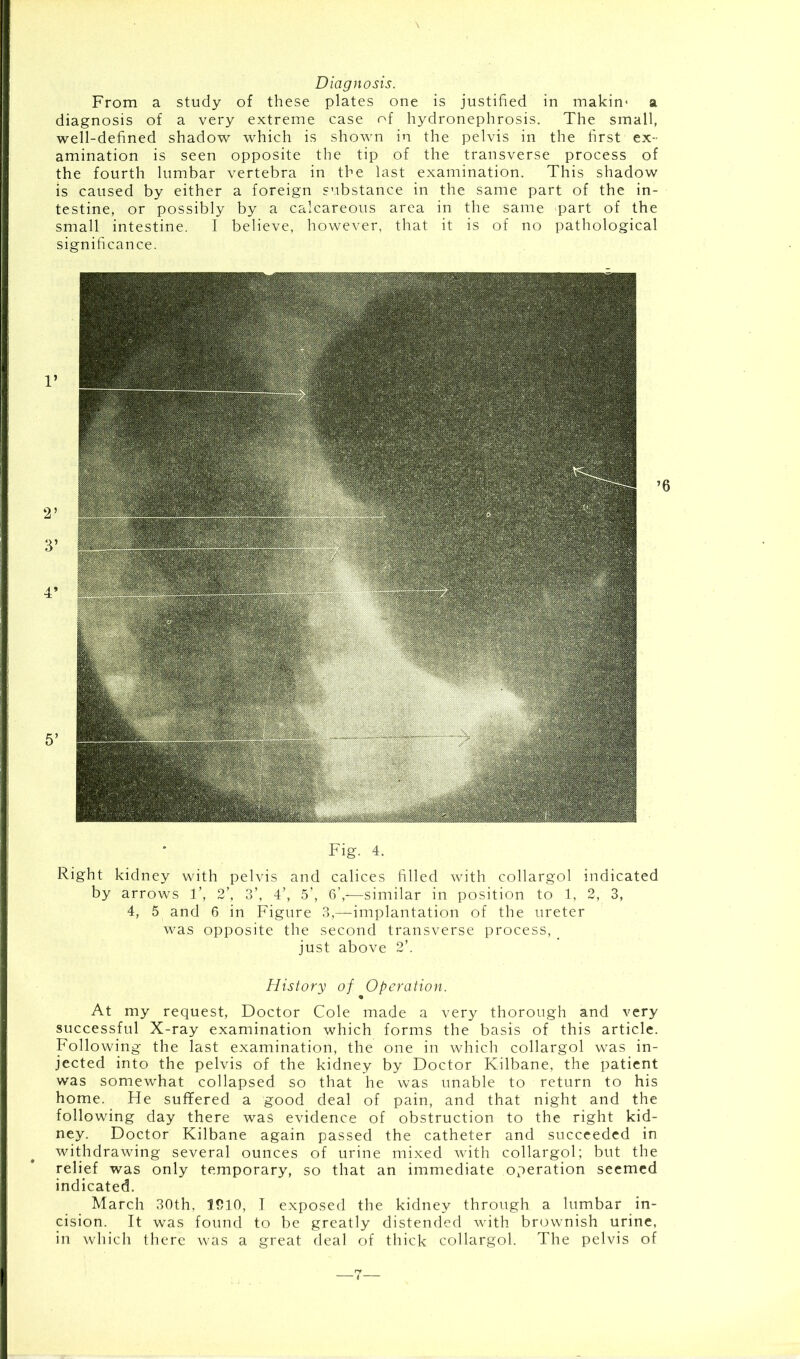 Diagnosis. From a study of these plates one is justified in makim at diagnosis of a very extreme case of hydronephrosis. The small, well-defined shadow which is shown in the pelvis in the first ex- amination is seen opposite the tip of the transverse process of the fourth lumbar vertebra in the last examination. This shadow is caused by either a foreign substance in the same part of the in- testine, or possibly by a calcareous area in the same part of the small intestine. I believe, however, that it is of no pathological significance. Fig. 4. Right kidney with pelvis and calices filled with collargol indicated by arrows T, 2’, 3’, 4’, 5’, 6’,—similar in position to 1, 2, 3, 4, 5 and 6 in Figure 3,—implantation of the ureter was opposite the second transverse process, _ just above 2’. History of Operation. At my request, Doctor Cole made a very thorough and very successful X-ray examination which forms the basis of this article. Following the last examination, the one in which collargol was in- jected into the pelvis of the kidney by Doctor Kilbane, the patient was somewhat collapsed so that he was unable to return to his home. He suffered a good deal of pain, and that night and the following day there was evidence of obstruction to the right kid- ney. Doctor Kilbane again passed the catheter and succeeded in withdrawing several ounces of urine mixed with collargol; but the relief was only temporary, so that an immediate operation seemed indicated. March 30th, 1510, I exposed the kidney through a lumbar in- cision. It was found to be greatly distended with brownish urine, in which there was a great deal of thick collargol. The pelvis of