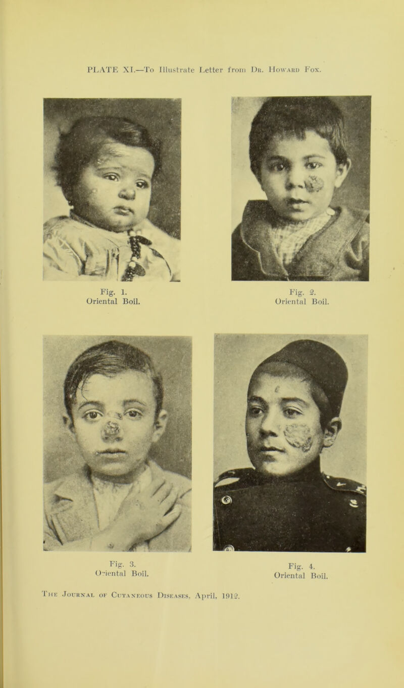 Fig. 2. Oriental Boil. Fig. 3. Oriental Boil. Fig. 4. Oriental Boil. The Journai, of Cutaneous Diseases, April. 1912.