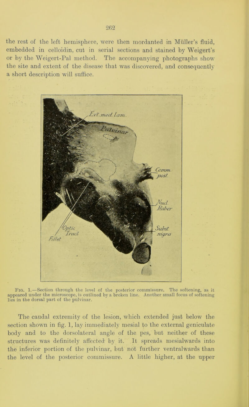 the rest of the left hemisphere, were then mordanted in Muller’s fluid, embedded in celloidin, cut in serial sections and stained by Weigert’s or by the Weigert-Pal method. The accompanying photographs show the site and extent of the disease that was discovered, and consequently a short description will suffice. Comm post. ( Fig. 1.—Section through the level of the posterior commissure. The softening, as it appeared under the microscope, is outlined by a broken line. Another small focus of softening lies in the dorsal part of the pulvinar. The caudal extremity of the lesion, which extended just below the section shown in fig. 1, lay immediately mesial to the external geniculate body and to the dorsolateral angle of the pes, but neither of these structures was definitely affected by it. It spreads mesialwards into the inferior portion of the pulvinar, but not further ventralwards than the level of the posterior commissure. A little higher, at the upper