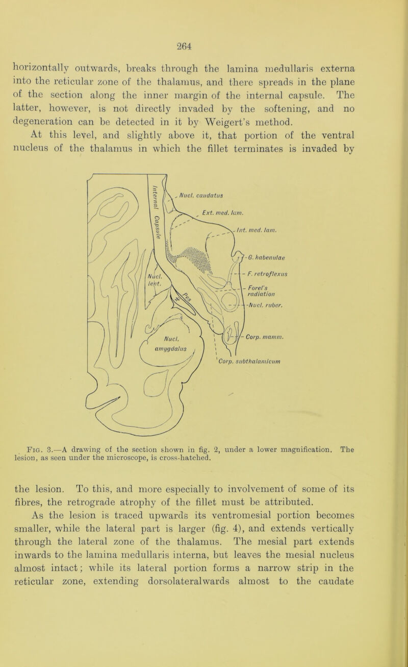 horizontally outwards, breaks through the lamina medullaris externa into the reticular zone of the thalamus, and there spreads in the plane of the section along the inner margin of the internal capsule. The latter, however, is not directly invaded by the softening, and no degeneration can be detected in it by Weigert’s method. At this level, and slightly above it, that portion of the ventral nucleus of the thalamus in which the fillet terminates is invaded by Fig. 3.—A drawing of the section shown in fig. 2, under a lower magnification. The lesion, as seen under the microscope, is cross-hatched. the lesion. To this, and more especially to involvement of some of its fibres, the retrograde atrophy of the fillet must be attributed. As the lesion is traced upwards its ventromesial portion becomes smaller, while the lateral part is larger (fig. 4), and extends vertically through the lateral zone of the thalamus. The mesial part extends inwards to the lamina medullaris interna, but leaves the mesial nucleus almost intact; while its lateral portion forms a narrow strip in the reticular zone, extending dorsolateralwards almost to the caudate