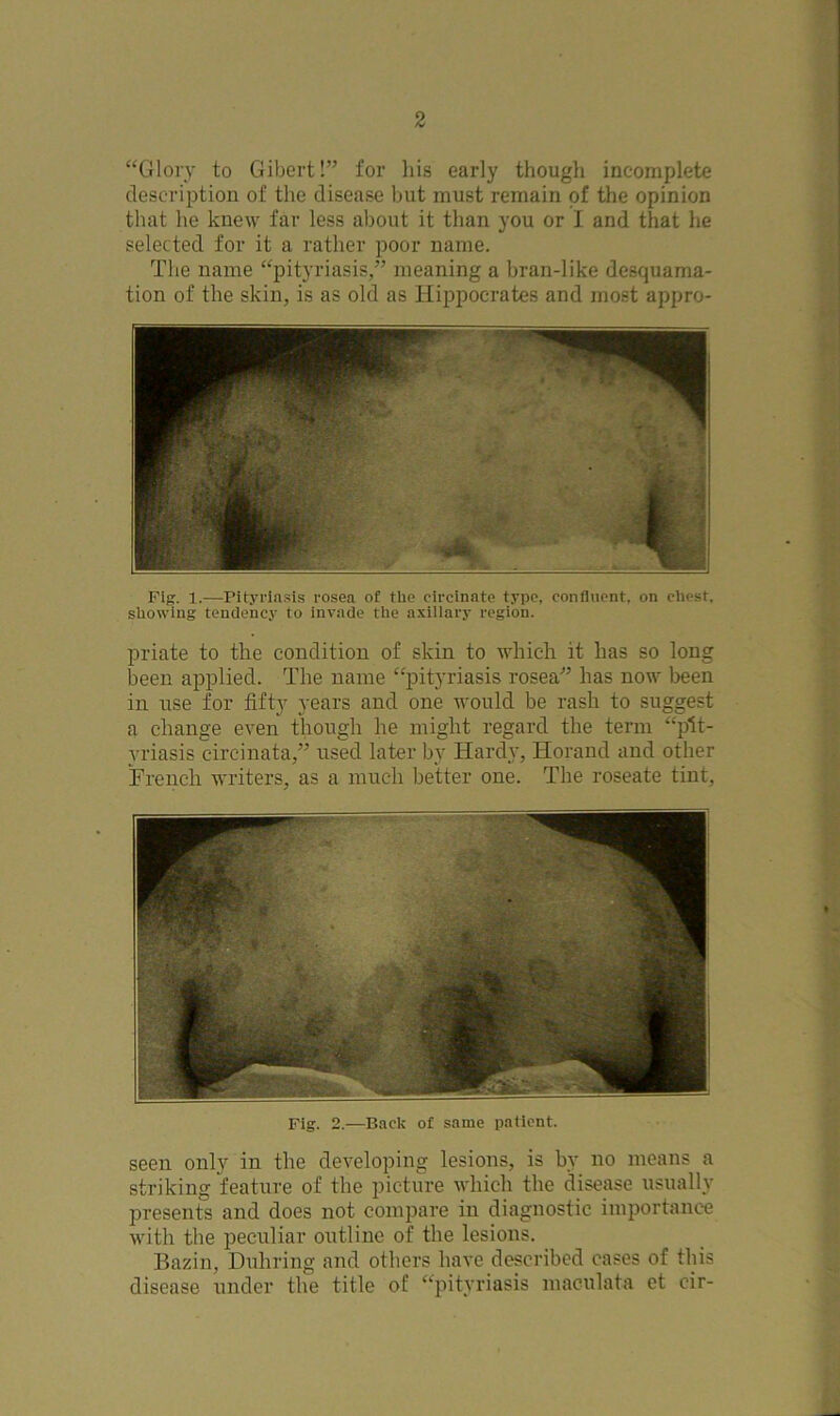 “Glory to Gibert!” for his early though incomplete description of the disease but must remain of the opinion that he knew far less about it than you or I and that he selected for it a rather poor name. The name “pityriasis,” meaning a bran-like desquama- tion of the skin, is as old as Hippocrates and most appro- Fig. 1.—Pityriasis rosea of tile circinate type, confluent, on chest, showing tendency to invade the axillary region. priate to the condition of skin to which it has so long been applied. The name “pityriasis rosea” has now been in use for fifty years and one would be rash to suggest a change even though he might regard the term “pit- yriasis circinata,” used later by Hardy, Horand and other French writers, as a much better one. The roseate tint. Fig. 2.—Back of same patient. seen only in the developing lesions, is by no means a striking feature of the picture which the disease usually presents and does not compare in diagnostic importance with the peculiar outline of the lesions. Bazin, Duhring and others have described cases of this disease under the title of “pityriasis maculata et cir-