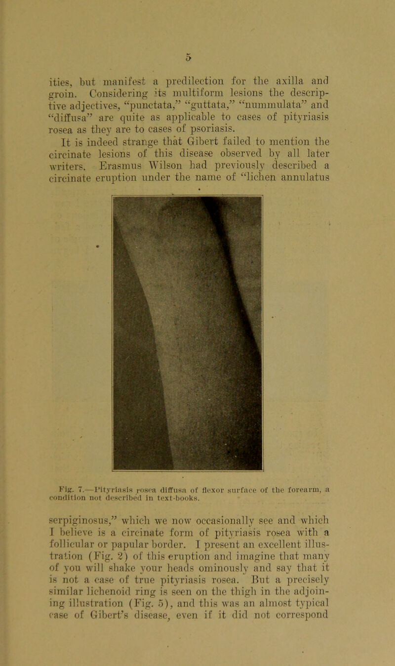 ities, but manifest a predilection for the axilla and groin. Considering its multiform lesions the descrip- tive adjectives, “punctata,” “guttata,” “nummulata” and “diffusa” are quite as applicable to cases of pityriasis rosea as they are to cases of psoriasis. It is indeed strange that Gibert failed to mention the circinate lesions of this disease observed by all later writers. Erasmus Wilson had previously described a circinate eruption under the name of “lichen annulatus Fig. 7.—I’ltyrinsls rosea diffusa of flexor surface of the forearm, a condition not described in text-books. serpiginosus,” which we now occasionally see and which I believe is a circinate form of pityriasis rosea with a follicular or papular border. I present an excellent illus- tration (Fig. 2) of this eruption and imagine that many of you will shake your heads ominously and say that it is not a case of true pityriasis rosea. But a precisely similar lichenoid ring is seen on the thigh in the adjoin- ing illustration (Fig. 5), and this was an almost typical case of Gibert’s disease, even if it did not correspond