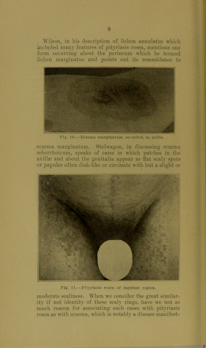 Wilson, in his description of lichen annulatus which included many features of pityriasis rosea, mention s one form occurring about the perineum which he termed lichen marginatus and points out its resemblance to Fig. 10,—Kesenia marginatum, so-called, in axilla. eczema marginatum. Stelwagon, in disenssing eczema seborrhoieum. speaks of cases in which patches in the axilhe and about the genitalia appear as flat scaly spots or papules often disk-like or circinate with but a slight or Fig. 11.— l’ityriasis rosea of inguinal region. moderate scaliucss. When we consider the great similar- ity if not identity of these scaly rings, have we not as much reason for associating such cases with pityriasis rosea as with eczema, which is notably a disease manifest-