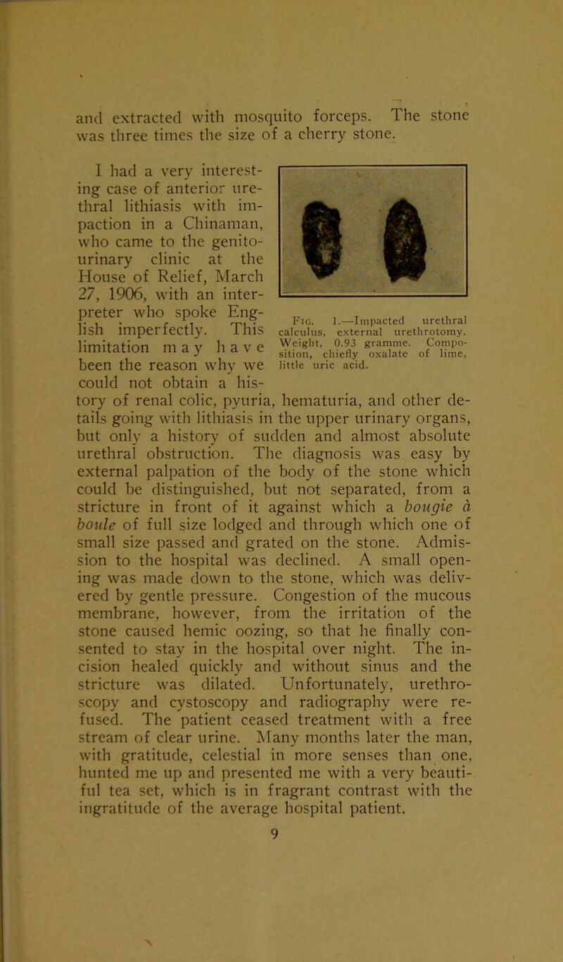 and extracted with mosquito forceps. The stone was three times the size of a cherry stone. I had a very interest- ing case of anterior ure- thral lithiasis with im- paction in a Chinaman, who came to the genito- urinary clinic at the House of Relief, March 27, 1906, with an inter- preter who spoke Eng- _ , . . ... f. , . e Ti r™ . 1*ig. 1.—Impacted urethral lisn imperiectly. 1 ill S calculus, external urethrotomy. Iimitfltinn tTl 3 v li Q V P Weight, 0.93 gramme. Compo- limuauon maj n <* \ e sition> chiefly oxalate of lime, been the reason why we nttie uric acid, could not obtain a his- tory of renal colic, pyuria, hematuria, and other de- tails going with lithiasis in the upper urinary organs, but only a history of sudden and almost absolute urethral obstruction. The diagnosis was easy by external palpation of the body of the stone which could be distinguished, but not separated, from a stricture in front of it against which a bougie a boule of full size lodged and through which one of small size passed and grated on the stone. Admis- sion to the hospital was declined. A small open- ing was made down to the stone, which was deliv- ered by gentle pressure. Congestion of the mucous membrane, however, from the irritation of the stone caused hemic oozing, so that he finally con- sented to stay in the hospital over night. The in- cision healed quickly and without sinus and the stricture was dilated. Unfortunately, urethro- scopy and cystoscopy and radiography were re- fused. The patient ceased treatment with a free stream of clear urine. Many months later the man, with gratitude, celestial in more senses than one, hunted me up and presented me with a very beauti- ful tea set, which is in fragrant contrast with the ingratitude of the average hospital patient.