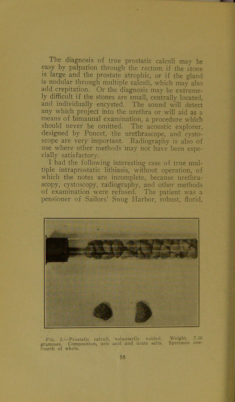 The diagnosis of true prostatic calculi may be easy by palpation through the rectum if the stone is large and the prostate atrophic, or if the gland is nodular through multiple calculi, which may also add crepitation. Or the diagnosis may be extreme- ly difficult if the stones are small, centrally located, and individually encysted. The sound will detect any which project into the urethra or will aid as a means of bimanual examination, a procedure which should never be omitted. The acoustic explorer, designed by Poncet, the urethrascope, and cysto- scope are very important. Radiography is also of use where other methods may not have been espe- cially satisfactory. I had the following interesting case of true mul- tiple intraprostatic lithiasis, without operation, of which the notes are incomplete, because urethra- scopy, cystoscopy, radiography, and other methods of examination were refused. The patient was a pensioner of Sailors’ Snug Harbor, robust, florid, Fig. 2.—Prostatic calculi, voluntarily voided. Weight. 7.36 grammes. Composition, uric acid and urate salts. Specimen one- fourth of whole.