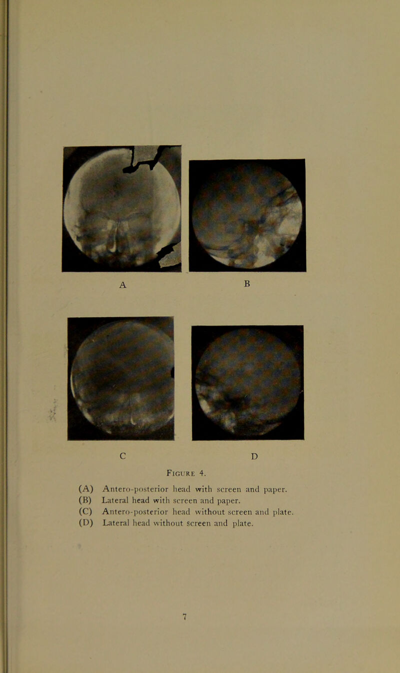 1*1, % „. C D Figure 4. (A) Antero-posterior head with screen and paper. (B) Lateral head with screen and paper. (C) Antero-posterior head without screen and plate. (D) Lateral head without screen and plate.