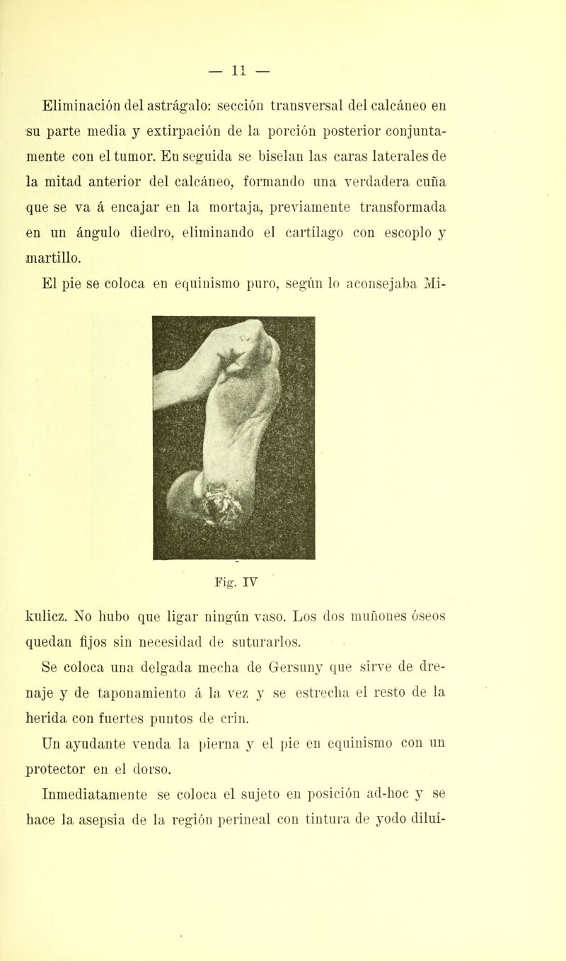 Eliminación del astrágalo: sección transversal del calcáneo en su parte media y extirpación de la porción posterior conjunta- mente con el tumor. En seguida se biselan las caras laterales de la mitad anterior del calcáneo, formando una verdadera cuña que se va á encajar en la mortaja, previamente transformada en un ángulo diedro, eliminando el cartílago con escoplo y martillo. El pie se coloca en equinismo puro, según lo aconsejaba Mi- Fig. IV kulicz. No hubo que ligar ningún vaso. Los dos muñones óseos quedan fijos sin necesidad de suturarlos. Se coloca una delgada mecha de Gersuny que sirve de dre- naje y de taponamiento á la vez y se estrecha el resto de la herida con fuertes puntos de crin. Un ayudante venda la pierna y el pie en equinismo con un protector en el dorso. Inmediatamente se coloca el sujeto en posición ad-hoc y se hace la asepsia de la región perineal con tintura de yodo diluí-