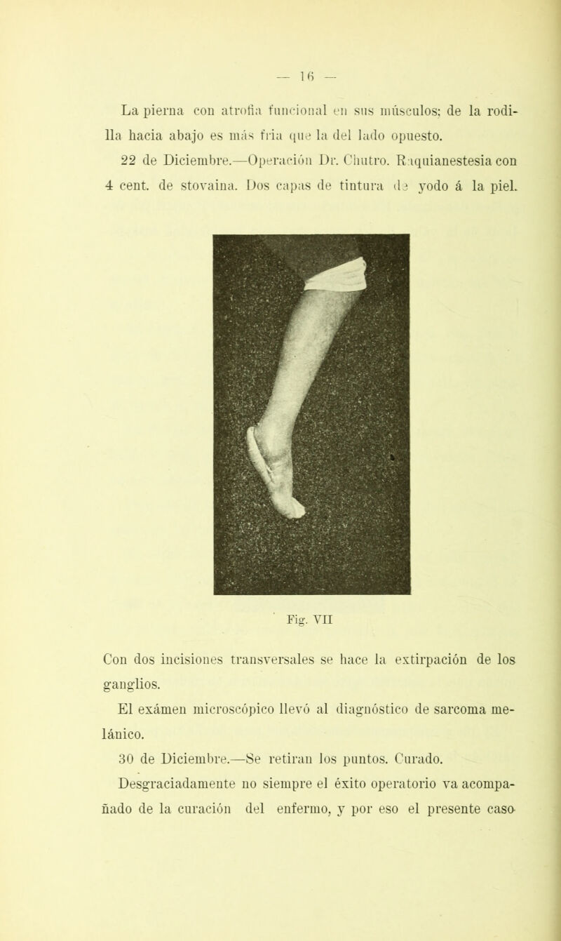 La pierna con atrofia funcional en sus músculos; de la rodi- lla hacia abajo es más fria que la del lado opuesto. 22 de Diciembre.—Operación Dr. Chutro. Riquianestesia con 4 cent, de stovaina. Dos capas de tintura de yodo á la piel. Fig. Vil Con dos incisiones transversales se hace la extirpación de los ganglios. El examen microscópico llevó al diagnóstico de sarcoma me- lánico. 30 de Diciembre.—Se retiran los puntos. Curado. Desgraciadamente no siempre el éxito operatorio va acompa- ñado de la curación del enfermo, y por eso el presente casa