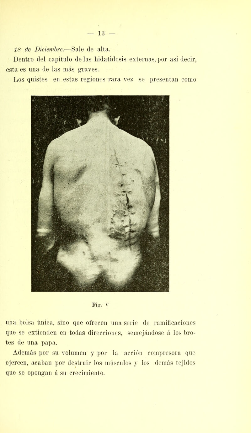 18 de Diciembre.—Sale de alta. Dentro del capítulo de las hidatidosis externas, por así decir, esta es una de las más graves. Los quistes en estas regiones raía vez se presentan como Fig. V una bolsa única, sino que ofrecen una serie de ramificaciones que se extienden en todas direcciones, semejándose á los bro- tes de una papa. Además por su volumen y por la acción compresora que ejercen, acaban por destruir los músculos y los demás tejidos que se opongan á su crecimiento.