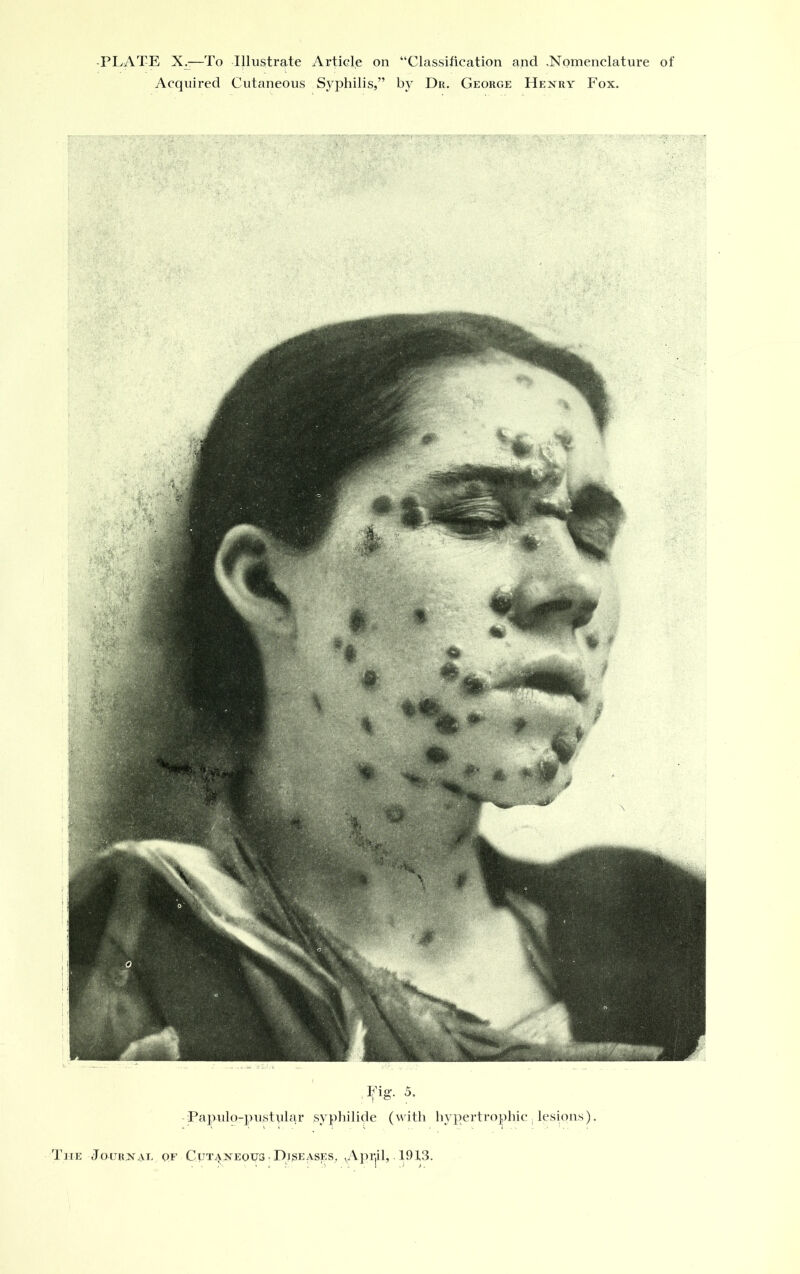 Acquired Cutaneous Syphilis,” by Dr. George Henry Fox. Fig- 5. Papulo-pustplar syphilide (with hypertrophic, lesions).