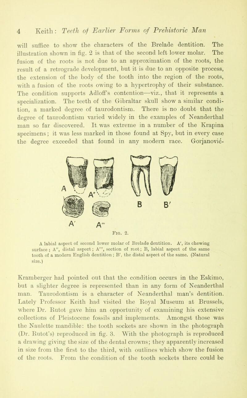 will suffice to show the characters of the Brelade dentition. The illustration shown in fig. 2 is that of the second left lower molar. The fusion of the roots is not due to an approximation of the roots, the result of a retrograde development, but it is due to an opposite process, the extension of the body of the tooth into the region of the roots, with a fusion of the roots owing to a hypertrophy of their substance. The condition supports AdlofFs contention—viz., that it represents a specialization. The teeth of the Gibraltar skull show a similar condi- tion, a marked degree of taurodontism. There is no doubt that the degree of taurodontism varied widely in the examples of Neanderthal man so far discovered. It. was extreme in a number of the Krapina specimens; it was less marked in those found at Spy, but in every case the degree exceeded that found in any modern race. Gorjanovic- Fig. 2. A labial aspect of second lower molar of Brelade dentition. A', its chewing surface ; A, distal aspect; A', section of root; B, labial aspect of the same tooth of a modern English dentition ; B', the distal aspect of the same. (Natural size.) Kramberger had pointed out that the condition occurs in the Eskimo, but a slighter degree is represented than in any form of Neanderthal man. Taurodontism is a character of Neanderthal man’s dentition. Lately Professor Keith had visited the Koyal Museum at Brussels, where Dr. Kutot gave him an opportunity of examining his extensive collections of Pleistocene fossils and implements. Amongst those was the Naulette mandible: the tooth sockets are shown in the photograph (Dr. Butot’s) reproduced in fig. 3. With the photograph is reproduced a drawing giving the size of the dental crowns; they apparently increased in size from the first to the third, with outlines which show the fusion of the roots. From the condition of the tooth sockets there could be