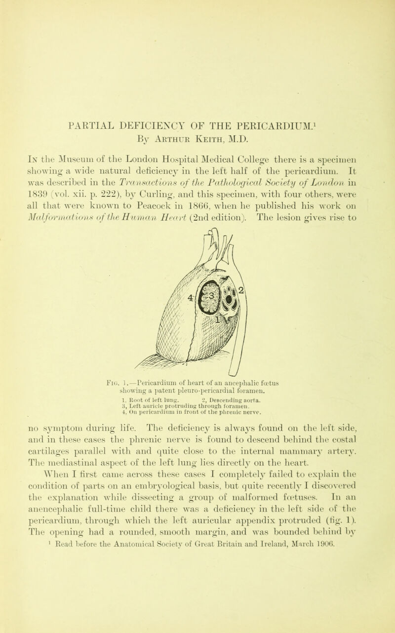 PARTIAL DEFICIENCY OF THE PERICARDIUM.1 By Arthur Keith, M.D. Ix the Museum of the London Hospital Medical College there is a specimen showing a wide natural deficiency in the left half of the pericardium. It was described in the Transactions of the Pathological Society of London in 1839 (vol. xii. p. 222), by Curling, and this specimen, with four others, were all that were known to Peacock in 1866, when he published his work on Malformations of the Human Heart (2nd edition). The lesion gives rise to Fig. 1.—Pericardium of lieart of an ancephalic foetus showing a patent pleuro-pericardial foramen. 1. Root of left lung. 2, Descending aorta. 3, Left auricle protruding through foramen. 4, On pericardium in front of the phrenic nerve. no symptom during life. The deficiency is always found on the left side, and in these cases the phrenic nerve is found to descend behind the costal cartilages parallel with and quite close to the internal mammary artery. The mediastinal aspect of the left lung lies directly on the heart. When I first came across these cases I completely failed to explain the condition of parts on an embryological basis, but quite recent^ I discovered the explanation while dissecting a group of malformed foetuses. In an anencephalic full-time child there was a deficiency in the left side of the pericardium, through which the left auricular appendix protruded (fig. 1). The opening had a rounded, smooth margin, and was bounded behind by 1 Read before the Anatomical Society of Great Britain and Ireland, March 1906.