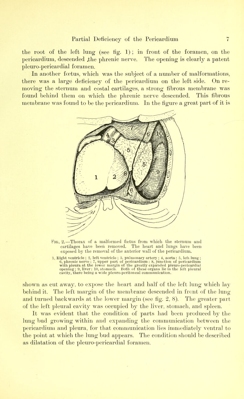 the root of the left lung (see fig. 1); in front of the foramen, on the pericardium, descended .the phrenic nerve. The opening is clearly a patent pleuro-pericardial foramen. In another foetus, which was the subject of a number of malformations, there was a large deficiency of the pericardium on the left side. On re- moving the sternum and costal cartilages, a strong fibrous membrane was found behind them on which the phrenic nerve descended. This fibrous membrane was found to be the pericardium. In the figure a great part of it is Fig. 2. ^-Thorax of a malformed foetus from which the sternum and cartilages have been removed. The heart and lungs have been exposed by the removal of the anterior wall of the pericardium. 1, Kiglit ventricle ; 2, left ventricle ; 3, pulmonary artery ; 4, aorta; 5, left lung ; 6, phrenic nerve ; 7, upper part of pericardium ; 8, junction of pericardium with pleura at the lower margin of the greatly expanded pleuro-pericardial opening ; 9, liver; 10, stomach. Both of these organs lie in the left pleural cavity, there being a wide pleuro-peritoneal communication. shown as cut away, to expose the heart and half of the left lung which lay behind it. The left margin of the membrane descended in front of the lung and turned backwards at the lower margin (see fig. 2, 8). The greater part of the left pleural cavity was occupied by the liver, stomach, and spleen. It was evident that the condition of parts had been produced by the lung bud growing within and expanding the communication between the pericardium and pleura, for that communication lies immediately ventral to the point at which the lung bud appears. The condition should be described as dilatation of the pleuro-pericardial foramen.