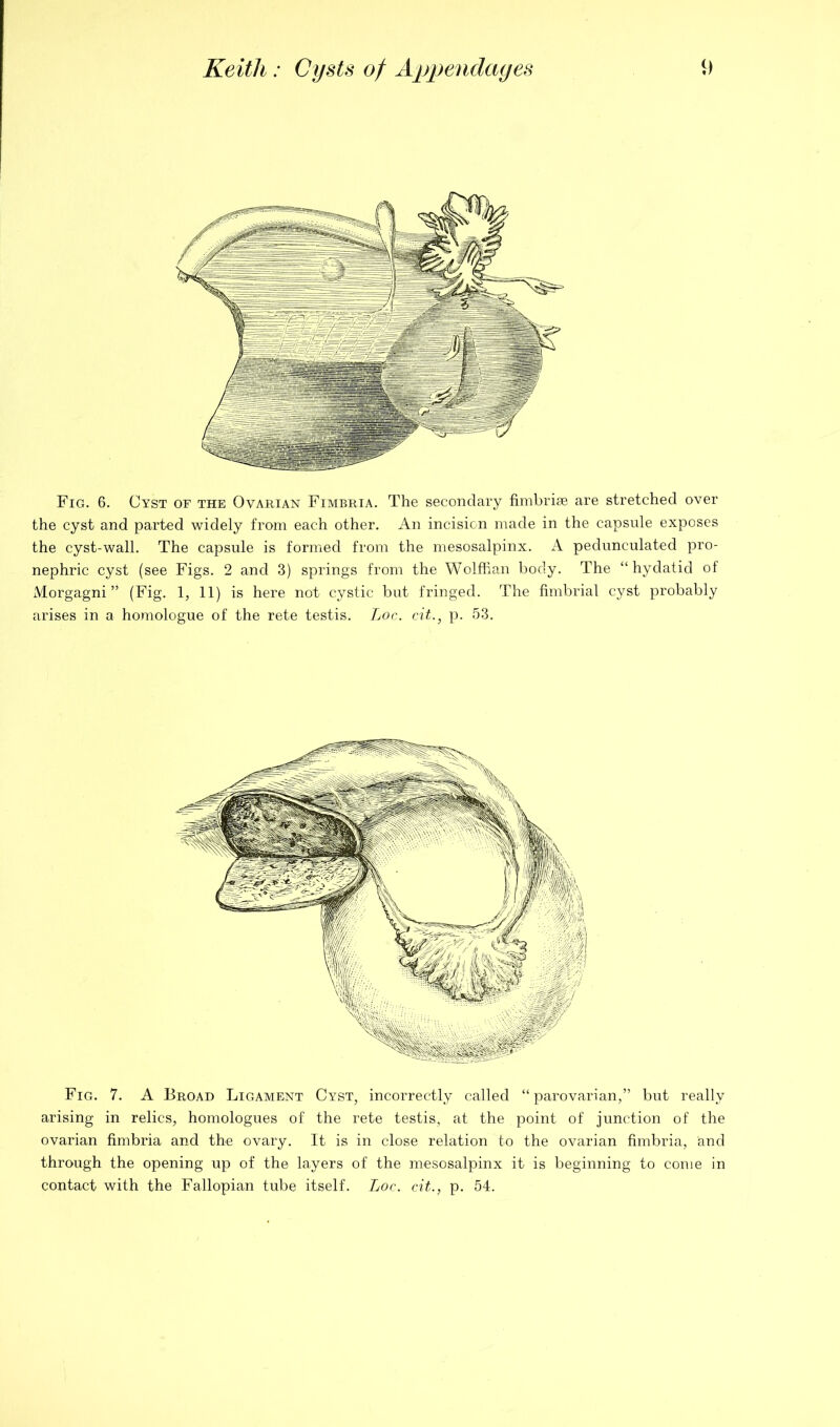 Fig. 6. Cyst of the Ovarian Fimbria. The secondary fimbriae are stretched over the cyst and parted widely from each other. An incisicn made in the capsule exposes the cyst-wall. The capsule is formed from the mesosalpinx. A pedunculated pro- nephric cyst (see Figs. 2 and 3) springs from the Wolffian body. The “hydatid of Morgagni” (Fig. 1, 11) is here not cystic but fringed. The fimbrial cyst probably arises in a homologue of the rete testis. Lor. cit.^ p. 53. Fig. 7. A Broad Ligament Cyst, incorrectly called “parovarian,” but really arising in relics, homologues of the rete testis, at the point of junction of the ovarian fimbria and the ovary. It is in close relation to the ovarian fimbria, and through the opening up of the layers of the mesosalpinx it is beginning to come in contact with the Fallopian tube itself. Loc. cit., p. 54.