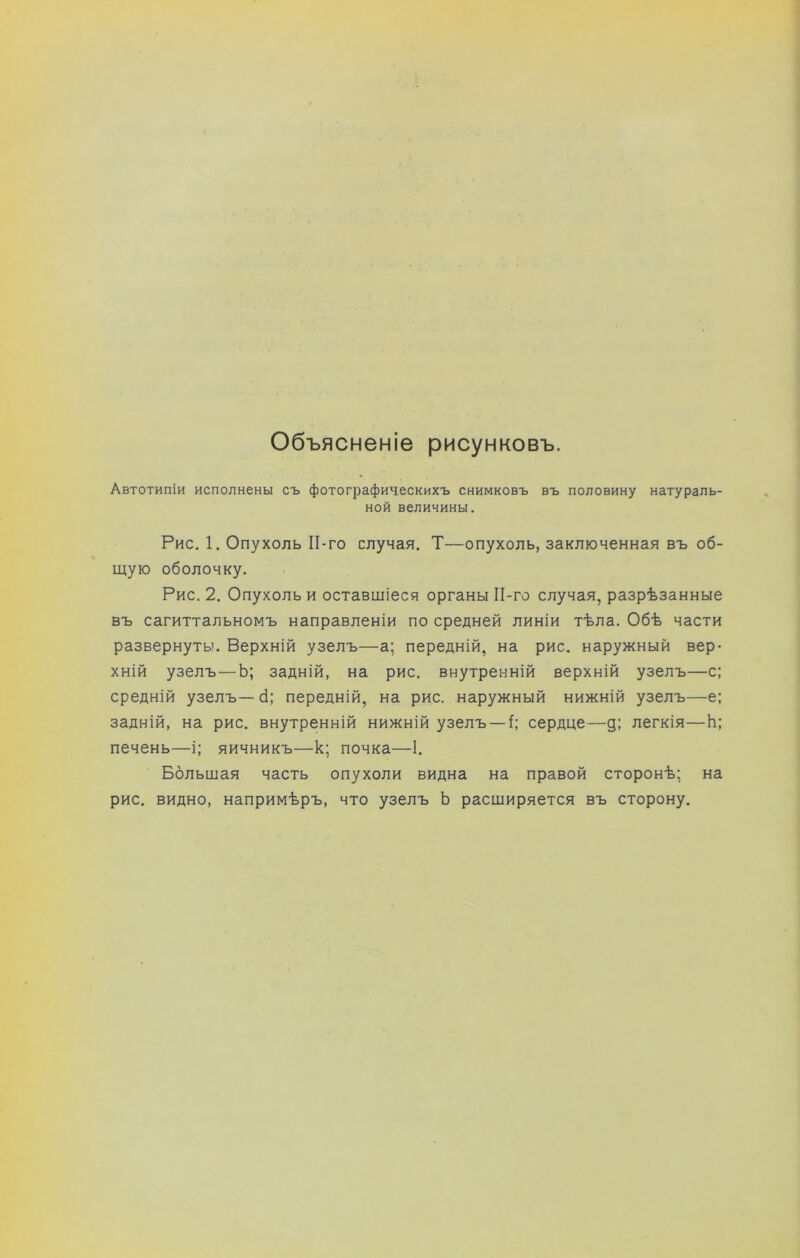 Объясненіе рисунковъ. Автотипіи исполнены съ фотографическихъ снимковъ въ половину натураль- ной величины. Рис. 1. Опухоль ІІ-го случая. Т—опухоль, заключенная въ об- щую оболочку. Рис. 2. Опухоль и оставшіеся органы ІІ-го случая, разрѣзанные въ сагиттальномъ направленіи по средней линіи тѣла. Обѣ части развернуты. Верхній узелъ—а; передній, на рис. наружный вер- хній узелъ—Ь; задній, на рис. внутренній верхній узелъ—с; средній узелъ— б; передній, на рис. наружный нижній узелъ—е; задній, на рис. внутренній нижній узелъ — I; сердце—д; легкія—Ь; печень—і; яичникъ—к; почка—1. Большая часть опухоли видна на правой сторонѣ; на рис. видно, напримѣръ, что узелъ Ь расширяется въ сторону.
