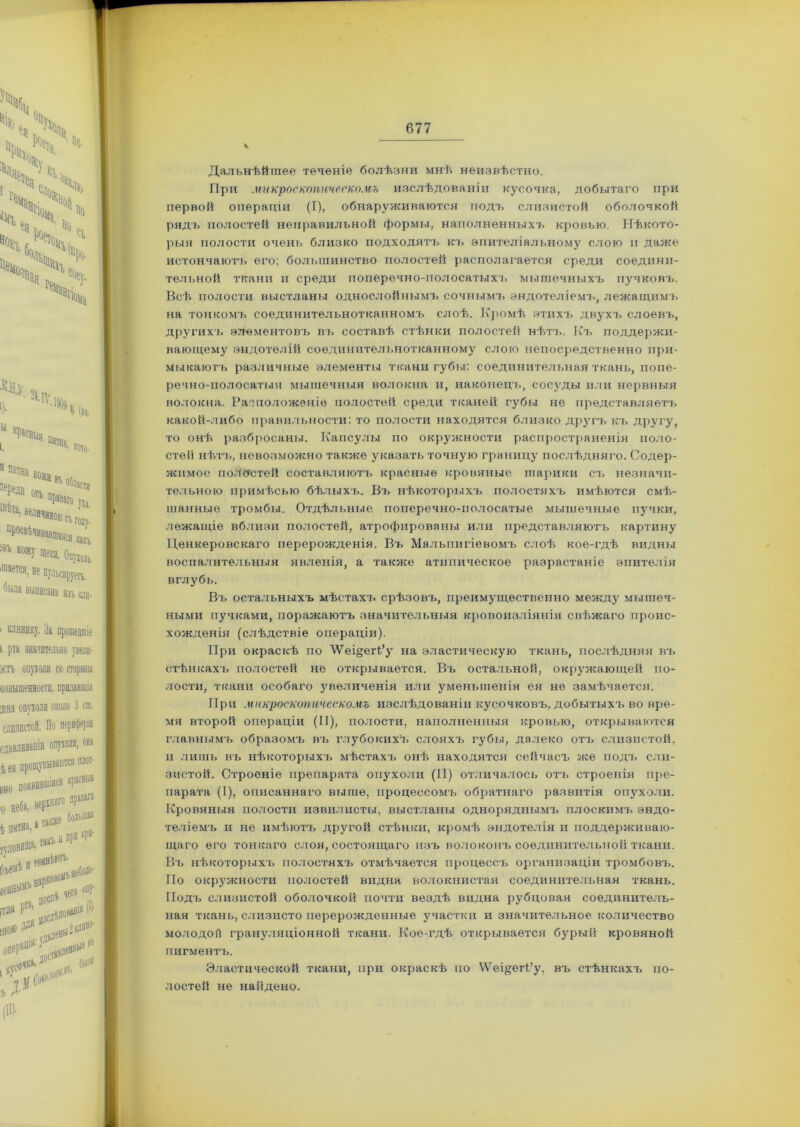 Дальнѣйшее теченіе болѣзни мнѣ неизвѣстно. При микроскопическомъ изслѣдованіи кусочка, добытаго при первой операціи (Т), обнаруживаются подъ слизистой оболочкой рядъ полостей неправильной формы, наполненныхъ кровью. Нѣкото- рыя полости очень близко подходятъ къ эпителіальному слою и даже истончаютъ его; большинство полостей располагается среди соедини- тельной ткани и среди поперечно-полосатыхъ мышечныхъ пучковъ. Всѣ полости выстланы однослойнымъ сочнымъ эндотеліемъ, лежащимъ на тонкомъ соединительнотканномъ слоѣ. Кромѣ этихъ двухъ слоевъ, другихъ элементовъ въ составѣ стѣнки полостей нѣтъ. Къ поддержи- вающему эндотелій соединительнотканному слою непосредственно при- мыкаютъ различные элементы ткани губы: соединительная ткань, попе- речно-полосатыя мышечныя волокна и, наконецъ, сосуды или нервныя волокна. Расположеніе полостей среди тканей губы не представляетъ какой-либо правильности: то полости находятся близко другъ къ другу, то онѣ разбросаны. Капсулы по окружности распространенія поло- стей нѣтъ, невозможно также указать точную границу послѣдняго. Содер- жимое полостей составляютъ красные кровяные шарики съ незначи- тельною примѣсью бѣлыхъ. Въ нѣкоторыхъ полостяхъ имѣются смѣ- шанные тромбы. Отдѣльные поперечно-полосатые мышечные пучки, лежащіе вблизи полостей, атрофированы или представляютъ картину Ценкеровскаго перерожденія. Въ Мальпигіевомъ слоѣ кое-гдѣ видны воспалительныя явленія, а также атипическое разрастаніе эпителія вглубь. Въ остальныхъ мѣстахъ срѣзовъ, преимущественно между мышеч- ными пучками, поражаютъ значительныя кровоизліянія свѣжаго проис- хожденія (слѣдствіе операціи). При окраскѣ по ’ѴѴеі^егк’у на эластическую ткань, послѣдняя въ стѣнкахъ полостей не открывается. Въ остальной, окружающей по- лости, ткани особаго увеличенія или уменьшенія ея не замѣчается. При микроскопическомъ изслѣдованіи кусочковъ, добытыхъ во вре- мя второй операціи (II), полости, наполненныя кровью, открываются главнымъ образомъ въ глубокихъ слояхъ губы, далеко отъ слизистой, и лишь въ нѣкоторыхъ мѣстахъ онѣ находятся сейчасъ же подъ сли- зистой. Строеніе препарата опухоли (II) отличалось отъ строенія пре- парата (I), описаннаго выше, процессомъ обратнаго развитія опухоли. Кровяныя полости извилисты, выстланы одноряднымъ плоскимъ эндо- теліемъ и не имѣютъ другой стѣнки, кромѣ эндотелія и поддерживаю- щаго его тонкаго слоя, состоящаго изъ волоконъ соединительной ткани. Въ нѣкоторыхъ полостяхъ отмѣчается процессъ организаціи тромбовъ. По окружности полостей видна волокнистая соединительная ткань. Подъ слизистой оболочкой почти вездѣ видна рубцовая соединитель- ная ткань, слизисто перерожденные участки и значительное количество молодой грануляціонной ткани. Кое-гдѣ открывается бурый кровяной пигментъ. Эластической ткани, при окраскѣ по \Ѵеі^егІ’у, въ стѣнкахъ по- лостей не найдено.