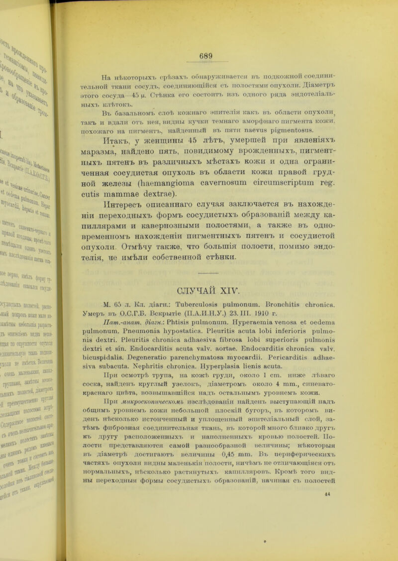 На нѣкоторыхъ срѣзахъ обнаруживается въ подкожной соедини- тельной ткани сосудъ, соединяющійся съ полостями опухоли. Діаметръ этого сосуда 45 р. Стѣнка его состоитъ изъ одного ряда эндотеліаль- ныхъ клѣтокъ. Въ базальномъ слоѣ кожнаго эпителія какъ въ области опухоли) такъ и вдали отъ нея, видны кучки темнаго аморфнаго пигмента кожи, похожаго на пигментъ, найденный въ пяти паеѵий рі^тепіозиз. Итакъ, у женщины 45 лѣтъ, умершей при явленіяхъ маразма, найдено пять, повидимому врожденныхъ, пигмент- ныхъ пятенъ въ различныхъ мѣстахъ кожи и одна ограни- ченная сосудистая опухоль въ области кожи правой груд- ной железы (Ъаетапдіота саѵегпозит сігситзсгірідіт ге&. сіПіз тагатае сіехйгае). Интересъ описаннаго случая заключается въ нахожде- ніи переходныхъ формъ сосудистыхъ образованій между ка- пиллярами и кавернозными полостями, а также въ одно- временномъ нахожденіи пигментныхъ пятенъ и сосудистой опухоли. Отмѣчу также, что большія полости, помимо эндо- телія, не имѣли собственной стѣнки. СЛУЧАЙ ХІУ. М. 65 л. Кл. діагн.: ТиЬегсиІозіз риішопит. ВгопсЬШз сЬгопіса. Умеръ въ О.С.Г.Б. Вскрытіе (П.А.И.Н.У.) 23. III. 1910 г. Пат.-анат. діагн.: РЫізіз рпітопит. Нурегаетіа ѵепоза еі оебета риішопит. Рпеитопіа Ьуро.зЬаПса. Ріеигііів асШа ІоЬі іпіегіогіэ риіто- піз (іехігі. РІеигШз сіігопіса абЬаезіѵа йЬгоза ІоЪі зиреічогіз риітопіз сіехігі еі зіп. ЕшіосагсіШз асШа ѵаіѵ. аогіае. ЕпйосагбШз сЬгопіса ѵаіѵ. Ъісизрісіаіів. Бе&епегаііо рагепсЬутаіоза туосагйіі. РегісагсІШз асІЬае- 8Іѵа зиЪасШа. ПерЬгШз сЬгопіса. Нурегріазіа Ііепіз асШа. При осмотрѣ трупа, на кожѣ груди, около 1 сш. ниже лѣваго соска, найденъ круглый узелокъ, діаметромъ около 4 шш., синевато- краснаго цвѣта, возвышавшійся надъ остальнымъ уровнемъ кожи. При микроскопическомъ изслѣдованіи найденъ выступающій надъ общимъ уровнемъ кожи небольшой плоскій бугоръ, въ которомъ ви- денъ нѣсколько истонченный и уплощенный эпителіальный слой, за- тѣмъ фиброзная соединительная ткань, въ которой много близко другъ къ другу расположенныхъ и наполненныхъ кровью полостей. По- лости представляются самой разнообразной величины; нѣкоторыя въ діаметрѣ достигаютъ величины 0,45 шш. Въ периферическихъ частяхъ опухоли видны маленькія полости, ничѣмъ не отличающіяся отъ нормальныхъ, нѣсколько растянутыхъ капилляровъ. Кромѣ того вид- ны переходныя формы сосудистыхъ образованій, начиная съ полостей 44