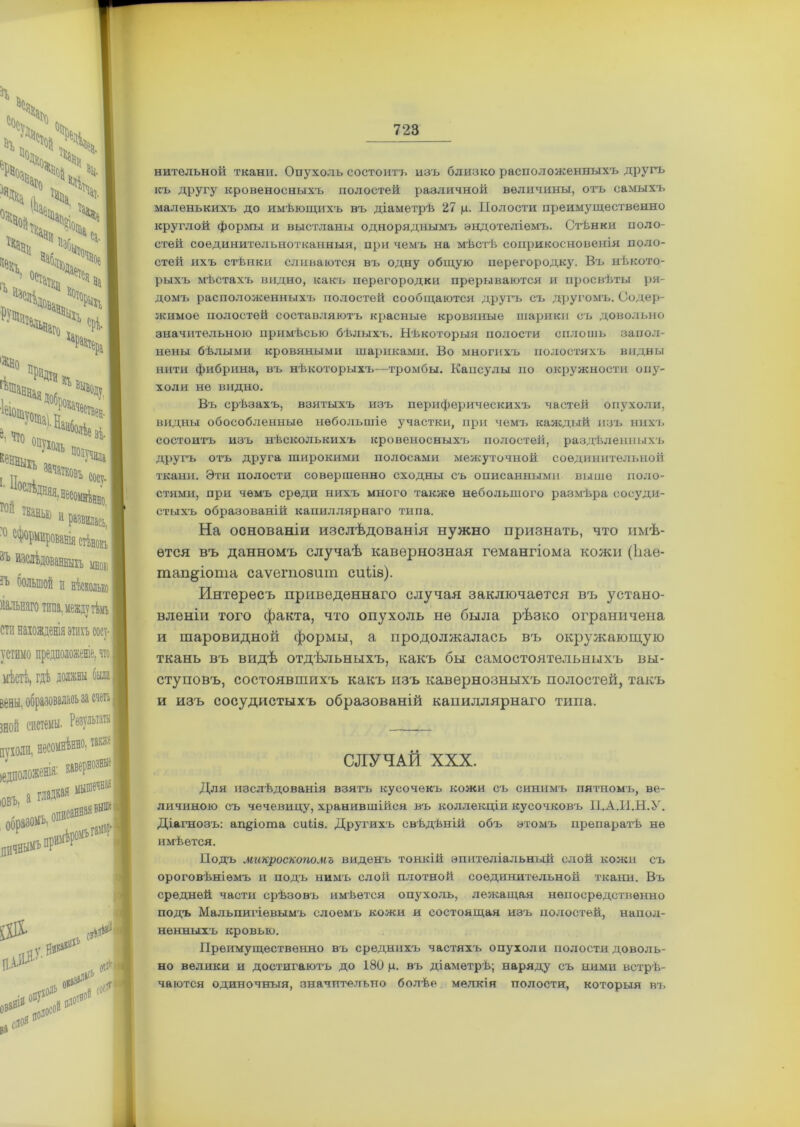 нительной ткани. Опухоль состоитъ изъ близко расположенныхъ другъ къ другу кровеносныхъ полостей различной величины, отъ самыхъ маленькихъ до имѣющихъ въ діаметрѣ 27 ц. Полости преимущественно круглой формы и выстланы одноряднымъ эндотеліемъ. Стѣнки поло- стей соединительнотканныя, при чемъ на мѣстѣ соприкосновенія поло- стей ихъ стѣнки сливаются въ одну общую перегородку. Въ нѣкото- рыхъ мѣстахъ видно, какъ перегородки прерываются и просвѣты ря- домъ расположенныхъ полостей сообщаются другъ съ другомъ. Содер- жимое полостей составляютъ красные кровяные шарики съ довольно значительною примѣсью бѣлыхъ. Нѣкоторыя полости сплошь запол- нены бѣлыми кровяными шариками. Во многихъ полостяхъ видны нити фибрина, въ нѣкоторыхъ—тромбы. Капсулы по окружности опу- холи не видно. Въ срѣзахъ, взятыхъ изъ периферическихъ частей опухоли, видны обособленные небольшіе участки, при чемъ каждый изъ нихъ состоитъ изъ нѣсколькихъ кровеносныхъ полостей, раздѣленныхъ другъ отъ друга широкими полосами межуточной соединительной ткани. Эти полости совершенно сходны съ описанными выше поло- стями, при чемъ среди нихъ много также небольшого размѣра сосуди- стыхъ образованій капиллярнаго типа. На основаніи изслѣдованія нужно признать, что имѣ- ется въ данномъ случаѣ кавернозная гемангіома кожи (Ііае- тап&іота саѵегпозшп спѣіа). Интересъ приведеннаго случая заключается въ устано- вленіи того факта, что опухоль не была рѣзко ограничена и шаровидной формы, а продолжалась въ окружающую ткань въ видѣ отдѣльныхъ, какъ бы самостоятельныхъ вы- ступовъ, состоявшихъ какъ изъ кавернозныхъ полостей, такъ и изъ сосудистыхъ образованій капиллярнаго типа. СЛУЧАЙ XXX. Для изслѣдованія взятъ кусочекъ кожи съ синимъ пятномъ, ве- личиною съ чечевицу, хранившійся въ коллекціи кусочковъ П.А.И.Н.У. Діагнозъ: ащрота сиіів. Другихъ свѣдѣній объ этомъ препаратѣ не имѣется. Подъ микроскопомъ виденъ тонкій эпителіальный слой кожи съ ороговѣніемъ и подъ нимъ слой плотной соединительной ткани. Въ средней части срѣзовъ имѣется опухоль, лежащая непосредственно подъ Мальпигіевымъ слоемъ кожи и состоящая изъ полостей, напол- ненныхъ кровью. Преимущественно въ среднихъ частяхъ опухоли полости доволь- но велики и достигаютъ до 180 р. въ діаметрѣ; наряду съ ними встрѣ- чаются одиночныя, значительно болѣе мелкія полости, которыя въ
