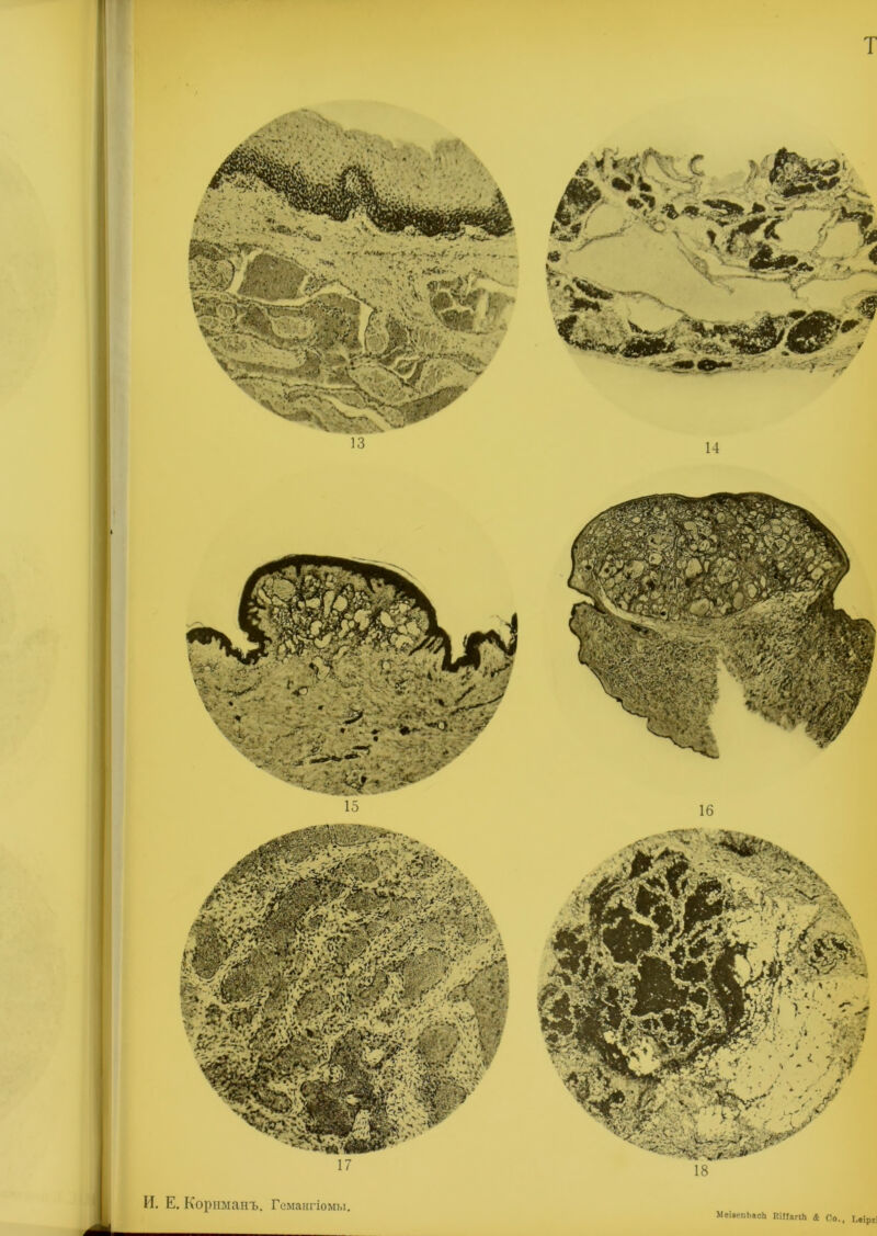 И. Е. Корішанъ. Гемангіомы МеівепЬасЬ КШагіЬ & Со., І,«іргі