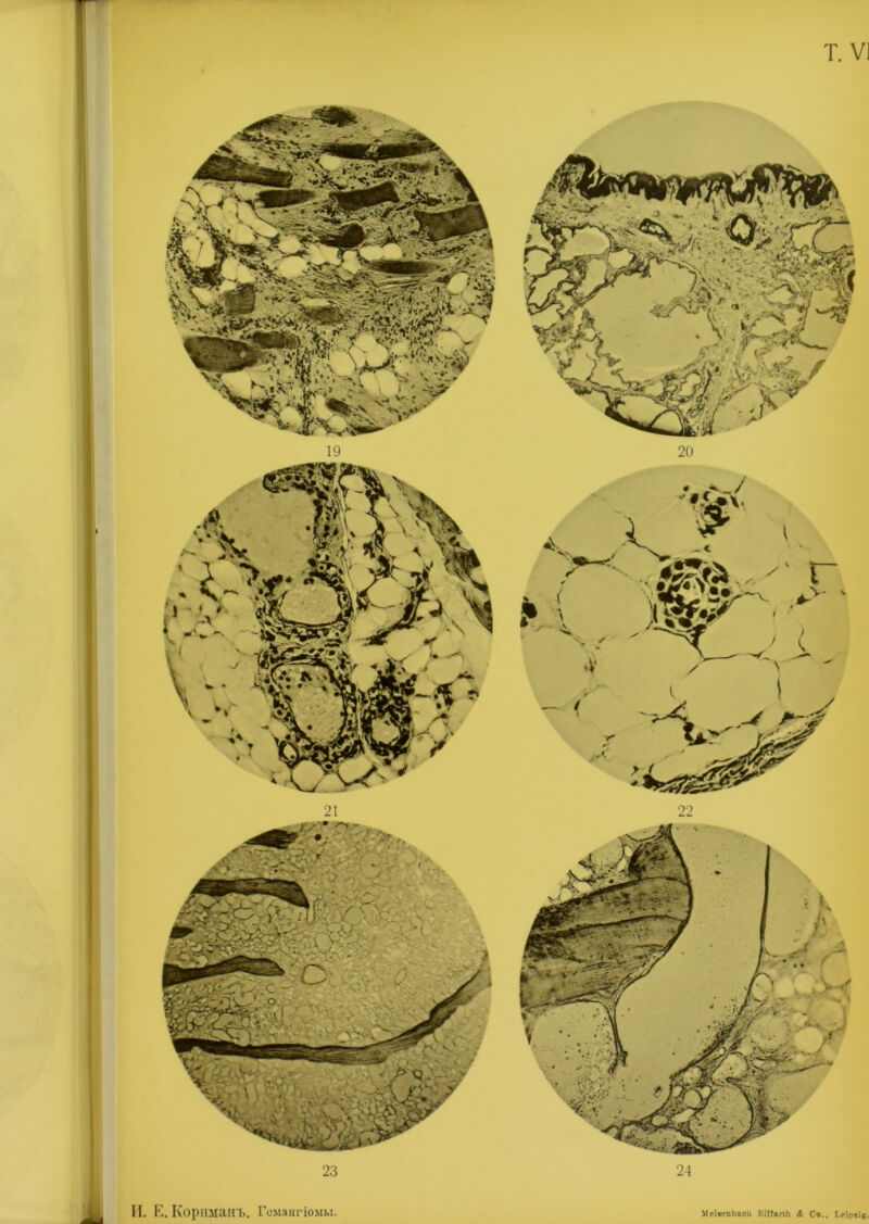 И. Е. Корнмапъ. Гемангіомы. Ме'иепЪасіі НІГІагІІі & Со., І.еіраі*.