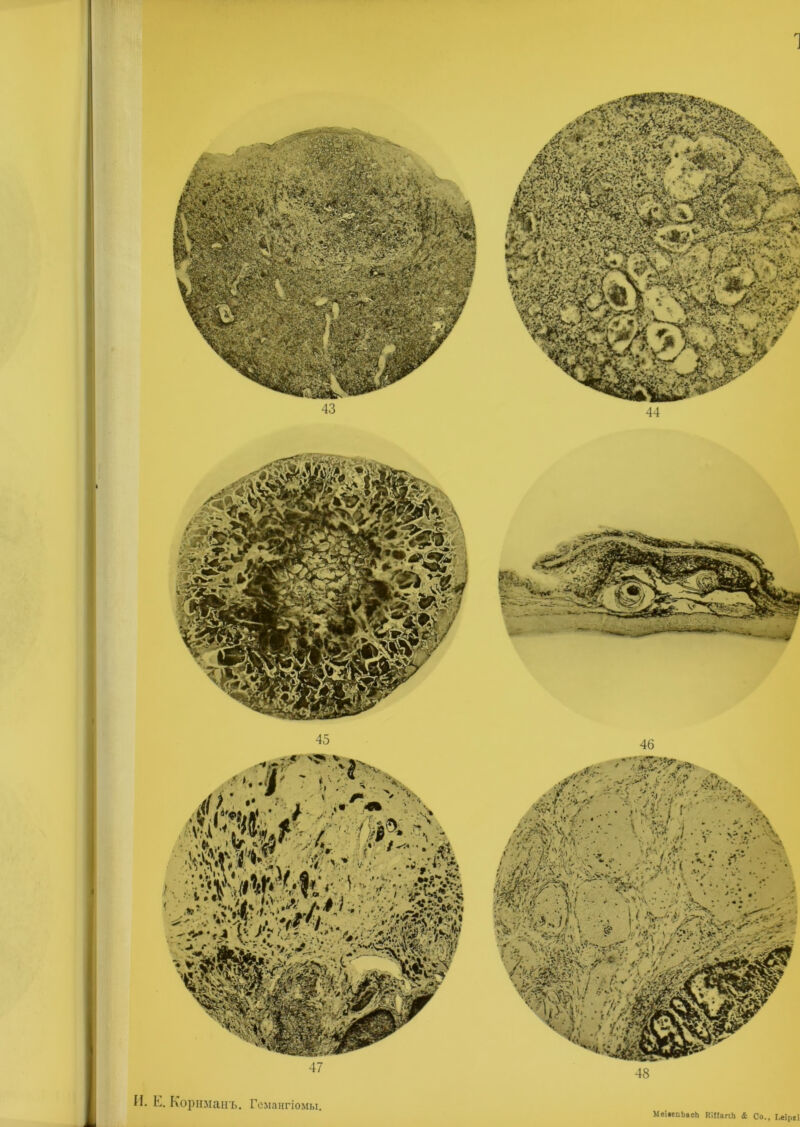 1 И. Е. Корнманъ. Гемангіомы МеімпЬасЬ КІИагіЬ & Со., І.еіргі