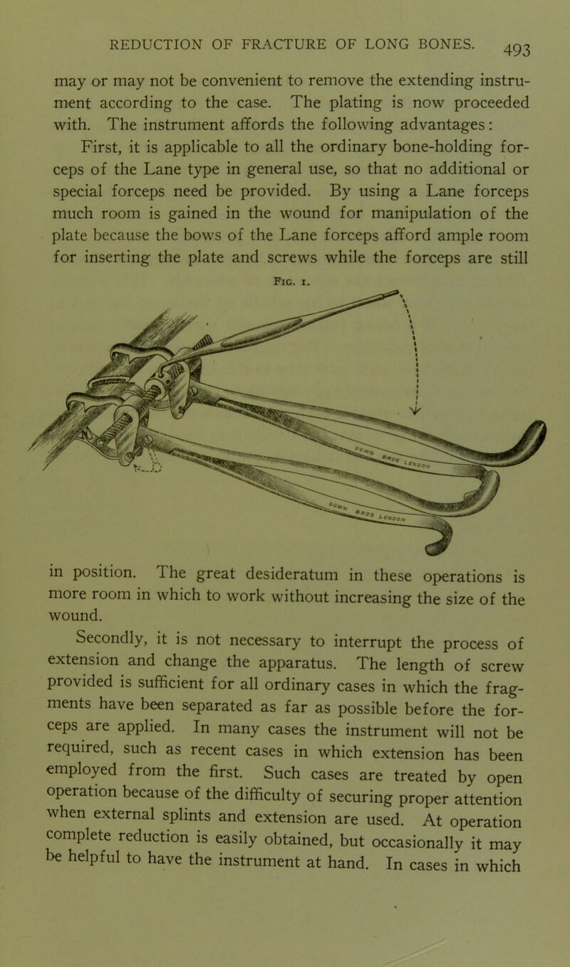 may or may not be convenient to remove the extending instru- ment according to the case. The plating is now proceeded with. The instrument affords the following advantages: First, it is applicable to all the ordinary bone-holding for- ceps of the Lane type in general use, so that no additional or special forceps need be provided. By using a Lane forceps much room is gained in the wound for manipulation of the plate because the bows of the Lane forceps afford ample room for inserting the plate and screws while the forceps are still Fig. 1. in position. The great desideratum in these operations is more room in which to work without increasing the size of the wound. Secondly, it is not necessary to interrupt the process of extension and change the apparatus. The length of screw provided is sufficient for all ordinary cases in which the frag- ments have been separated as far as possible before the for- ceps are applied. In many cases the instrument will not be required, such as recent cases in which extension has been employed from the first. Such cases are treated by open operation because of the difficulty of securing proper attention when external splints and extension are used. At operation complete reduction is easily obtained, but occasionally it may be helpful to have the instrument at hand. In cases in which