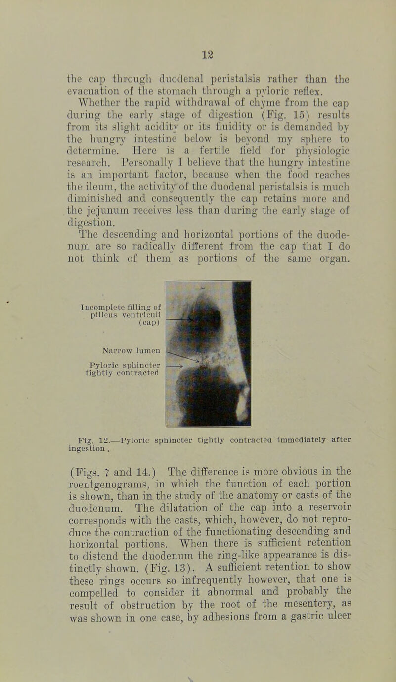 the cap through duodenal peristalsis rather than the evacuation of the stomach through a pyloric reflex. Whether the rapid withdrawal of chyme from the cap during the early stage of digestion (Fig. 15) results from its slight acidity or its fluidity or is demanded by the hungry intestine below is beyond my sphere to determine. Here is a fertile field for physiologic research. Personally I believe that the hungry intestine is an important factor, because when the food reaches the ileum, the activity of the duodenal peristalsis is much diminished and consequently the cap retains more and the jejunum receives less than during the early stage of digestion. The descending and horizontal portions of the duode- num are so radically different from the cap that I do not think of them as portions of the same organ. Incomplete filling of pilleus ventriculi (cap) Narrow lumen Pyloric sphincter tightly contracted Fig. 12.—Pyloric sphincter tightly contracted immediately after ingestion . (Figs. 7 and 14.) The difference is more obvious in the roentgenograms, in which the function of each portion is shown, than in the study of the anatomy or casts of the duodenum. The dilatation of the cap into a reservoir corresponds with the casts, which, however, do not repro- duce the contraction of the functionating descending and horizontal portions. When there is sufficient retention to distend the duodenum the ring-like appearance is dis- tinctly shown. (Fig. 13). A sufficient retention to show these rings occurs so infrequently however, that one is compelled to consider it abnormal and probably the result of obstruction by the root of the mesenterjq as was shown in one case, by adhesions from a gastric ulcer