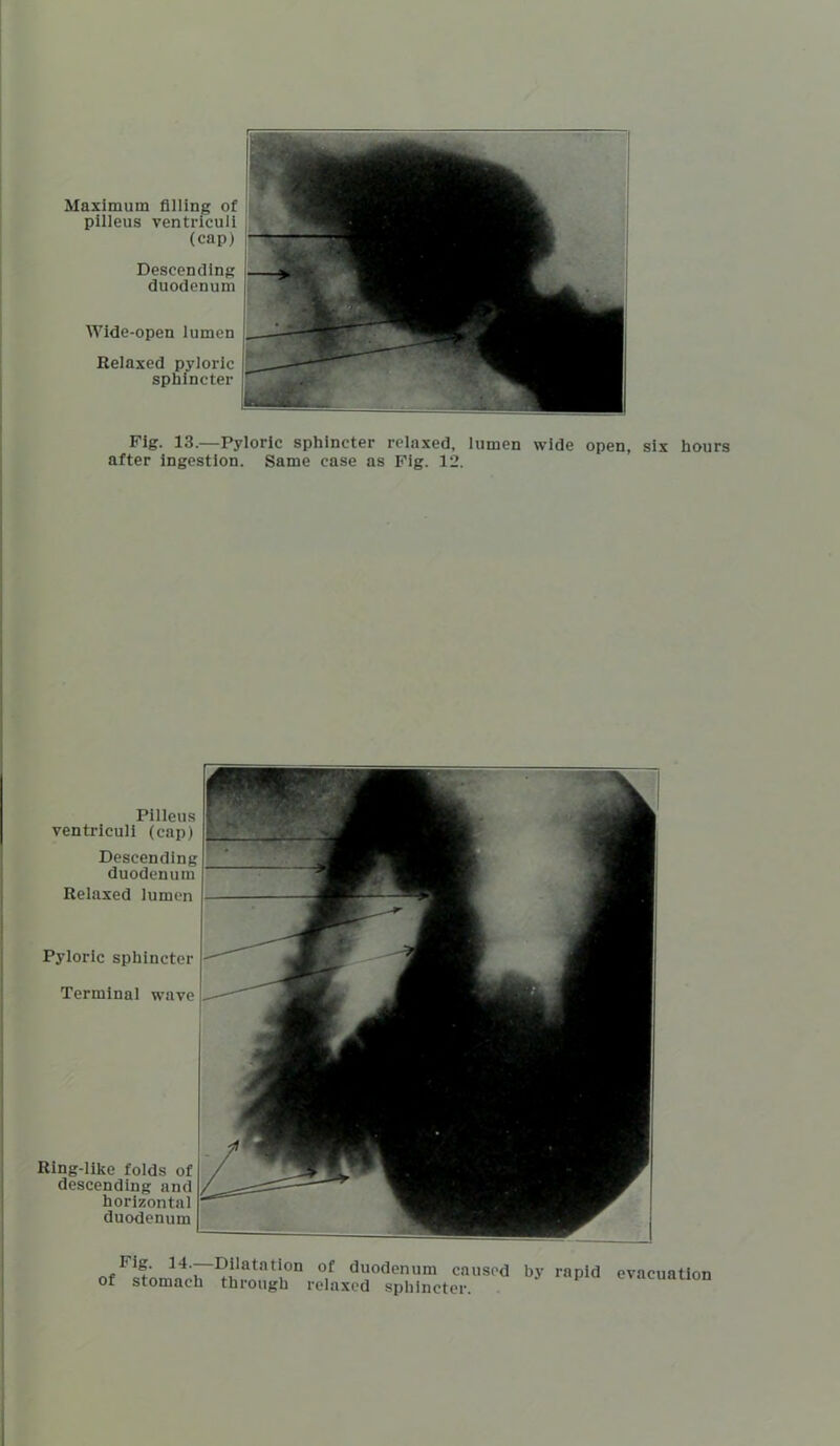 Maximum filling of pilleus ventriculi (cap) Descending duodenum Wide-open lumen Relaxed pyloric sphincter Fig. 13.—Pyloric sphincter relaxed, lumen wide open, six hours after ingestion. Same case as Fig. 12. Pyloric sphincter Terminal wave Ring-likc folds of descending and horizontal duodenum Pilleus ventriculi (cap) Descending duodenum Relaxed lumen of stomach through relaxed sphincter. by rapid evacuation